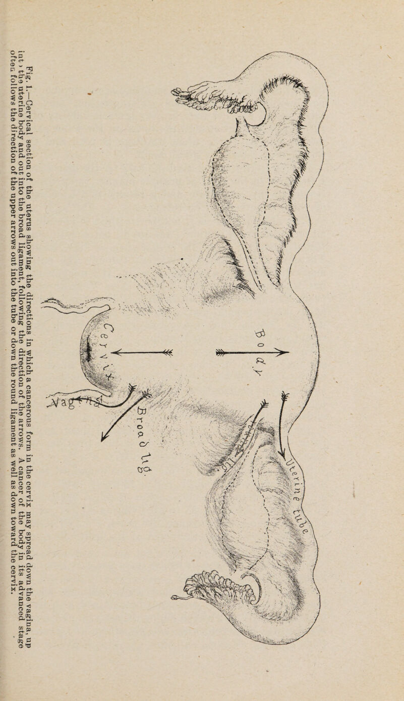 Fig. 1.—Cervical section of the uterus showing the directions in which a cancerous form in the cervix may spread down the vagina, up int) the uterine body and out into the broad ligament, following the direction of the arrows. A cancer of the body in its advanced stage often follows the direction of the upper arrows out into the tube or down the round ligament as well as down toward the cervix.