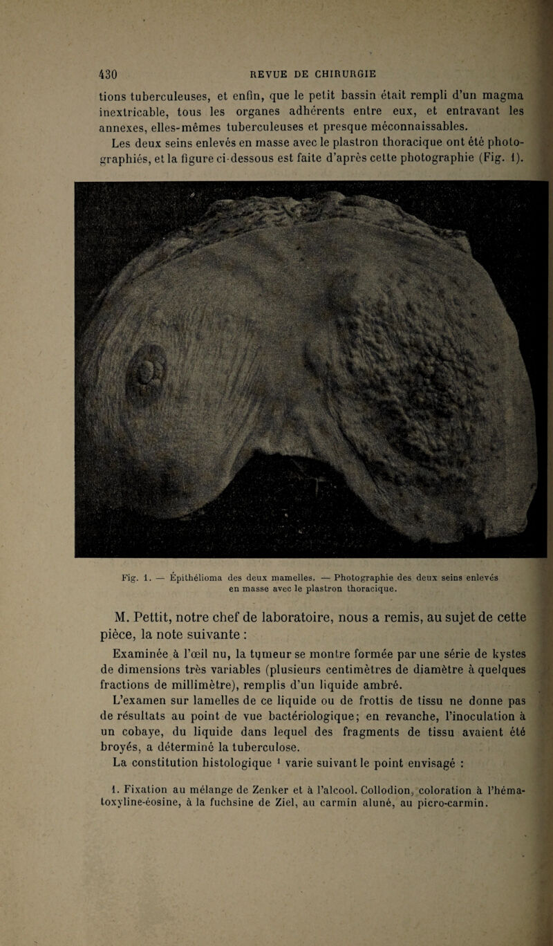 tions tuberculeuses, et enfin, que le petit bassin était rempli d’un magma inextricable, tous les organes adhérents entre eux, et entravant les annexes, elles-mêmes tuberculeuses et presque méconnaissables. Les deux seins enlevés en masse avec le plastron thoracique ont été photo¬ graphiés, et la figure ci-dessous est faite d’après cette photographie (Fig. 1). Fig. 1. — Épithélioma des deux mamelles. — Photographie des deux seins enlevés en masse avec le plastron thoracique. M. Pettit, notre chef de laboratoire, nous a remis, au sujet de cette pièce, la note suivante : Examinée à l’œil nu, la tqmeur se montre formée par une série de kystes de dimensions très variables (plusieurs centimètres de diamètre à quelques fractions de millimètre), remplis d’un liquide ambré. L’examen sur lamelles de ce liquide ou de frottis de tissu ne donne pas de résultats au point de vue bactériologique; en revanche, l’inoculation à un cobaye, du liquide dans lequel des fragments de tissu avaient été broyés, a déterminé la tuberculose. La constitution histologique 1 varie suivant le point envisagé : 1. Fixation au mélange de Zenker et à l’alcool. Collodion, coloration à l’héma- toxyline-éosine, à la fuchsine de Ziel, au carmin aluné, au picro-carmin.