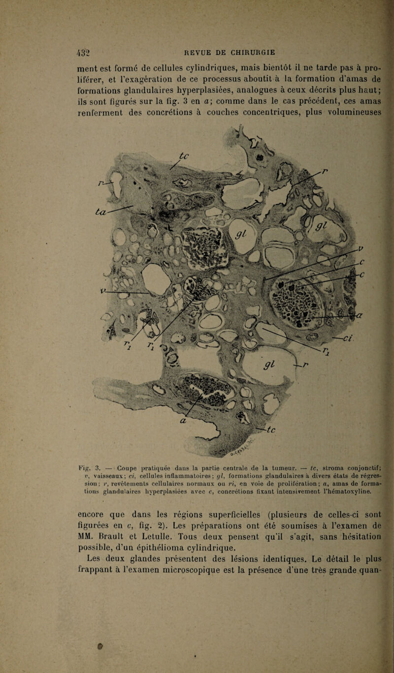 ment est formé de cellules cylindriques, mais bientôt il ne tarde pas à pro¬ liférer, et l’exagération de ce processus aboutit à la formation d’amas de formations glandulaires hyperplasiées, analogues à ceux décrits plus haut; ils sont figurés sur la fig. 3 en a; comme dans le cas précédent, ces amas renferment des concrétions à couches concentriques, plus volumineuses Fig. 3. — Coupe pratiquée dans la partie centrale de la tumeur. — te, sLroma conjonctif; v, vaisseaux; ci, cellules inflammatoires ; <jl, formations glandulaires à divers états de régres¬ sion ; r, revêtements cellulaires normaux ou ri, en voie de prolifération; a, amas de forma¬ tions glandulaires hyperplasiées avec c, concrétions fixant intensivement l’hématoxyline. encore que dans les régions superficielles (plusieurs de celles-ci sont figurées en c, fig. 2). Les préparations ont été soumises à l’examen de MM. Brault et Letulle. Tous deux pensent qu’il s’agit, sans hésitation possible, d’un épithélioma cylindrique. Les deux glandes présentent des lésions identiques. Le détail le plus frappant à l’examen microscopique est la présence d’une très grande quan-