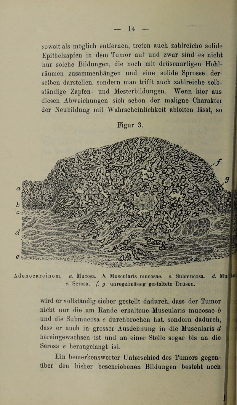 soweit als möglich entfernen, treten auch zahlreiche solide Epithelzapfen in dem Tumor auf und zwar sind es nicht nur solche Bildungen, die noch mit drüsenartigen Hohl¬ räumen Zusammenhängen und eine solide Sprosse der¬ selben darstellen, sondern man trifft auch zahlreiche selb¬ ständige Zapfen- und Mesterbildungen. Wenn hier aus diesen Abweichungen sich schon der maligne Charakter der Neubildung mit Wahrscheinlichkeit ableiten lässt, so Figur 3. Adenocarcinom. a. Mucosa. b. Muscularis mucosae, c. Submucosa. d. Musi e. Serosa. f, g. unregelmässig gestaltete Drüsen. wird er vollständig sicher gestellt dadurch, dass der Tumor nicht nur die am Bande erhaltene Muscularis mucosae b und die Submucosa c durchbrochen hat, sondern dadurch, dass er auch in grosser Ausdehnung in die Muscularis d $ hereingewachsen ist und an einer Stelle sogar bis an die jj Serosa e herangelangt ist. Ein bemerkenswerter Unterschied des Tumors gegen- n über den bisher beschriebenen Bildungen besteht noch <i fl