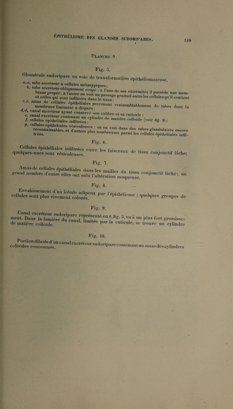 149 Planche 9 Fi. 5. Glomei-ule sudoi-ipai-e en voie de U-ansfoniiation éinthélioinatouse. «, «, tube sécréteur à cellules métatypiques • b, tube sécréteur obliquement romu» • rî i brane propre; à l’autre on voit un possède une meni- et celles qui sont infiltrées dans le tissu^^ gi’aduel entre les cellules qu’il contient mend3rar?flïïfit\nteîdilqt^^ vraisemblablement de tubes dont la d,d, canal excréteur ayant conservfi i épitllclicXlGS VGSiniîoncoc! • reconnaissables, et d’autres plus noiXm^’*^ ^ tubes glandulaii-es encore trées. ‘ parmi les cellules épithéliales infil- Fig. fi. Cellules épithéliales infiltrées inc r. •. . . quelques-unes sont vésiculcuses. ‘it'^ceaux de tissu conjonctif lâche; Fig. 7. K-and nombre dtuS snW UuéS'mtluou'ë. ^ cellules sont plus vivemcnrcolS.^'' ^ q^Hhélinnie : quelques groupes de ment. Dans la lumicïe^ïu^canj^l ^ grossisse- de matière colloïde. ’ cuticule, se trouve un cylindre Fig. 10.