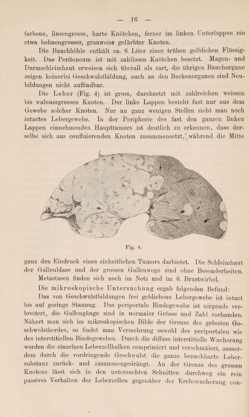 färbene, linsengrosse, harte Knötchen, ferner im linken Unterlappen ein etwa bohnengrosser, grauweiss gefärbter Knoten. Die Bauchhöhle enthält ca. 6 Liter einer trüben gelblichen Flüssig¬ keit. Das Peritoneum ist mit zahllosen Knötchen besetzt. Magen- und Darmschleimhaut erweisen sich überall als zart, die übrigen Bauchorgane zeigen keinerlei Geschwulstbildung, auch an den Beckenorganen sind Neu¬ bildungen nicht auffindbar. Die Leber (Fig. 4) ist gross, durchsetzt mit zahlreichen weissen bis walnussgrossen Knoten. Der linke Lappen besteht fast nur aus dem Gewebe solcher Knoten. Nur an ganz wenigen Stellen sieht man noch intactes Lehergewebe. In der Peripherie des fast den ganzen linken Lappen einnehmenden Haupttumors ist deutlich zu erkennen, dass der¬ selbe sich aus confluierenden Knoten zusammensetzt, während die Mitte Fig. 4. ganz den Eindruck eines einheitlichen Tumors darbietet. Die Schleimhaut der Gallenblase und der grossen Gallenwege sind ohne Besonderheiten. Metastasen finden sich noch im Netz und im 6. Brustwirbel. Die mikroskopische Untersuchung ergab folgenden Befund: Das von Geschwulstbildungen frei gebliebene Lebergewebe ist intact bis auf geringe Stauung. Das periportale Bindegewebe ist nirgends ver¬ breitert, die Gallengänge sind in normaler Grösse und Zahl vorhanden. Nähert man sich im mikroskopischen Bilde der Grenze des grössten Ge¬ schwulstherdes, so findet man Vermehrung sowohl des periportalen wie des interstitiellen Bindegewebes. Durch die diffuse interstitielle Wucherung werden die einzelnen Leberzellbalken comprimiert und verschmälert, ausser¬ dem durch die vordringende Geschwulst die ganze benachbarte Leber¬ substanz zurück- und zusammengedrängt. An der Grenze des grossen Knotens lässt sich in den untersuchten Schnitten durchweg ein rein passives Verhalten der Leberzellen gegenüber der Krebswucherung con-