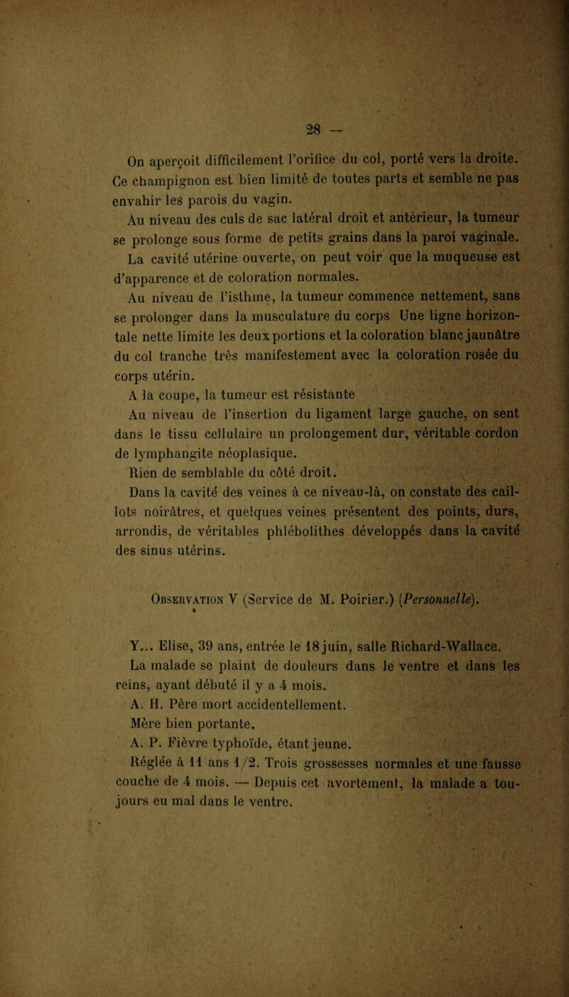 On aperçoit difficilement l’orifice du col, porté vers la droite. Ce champignon est bien limité de toutes parts et semble ne pas envahir les parois du vagin. Au niveau des culs de sac latéral droit et antérieur, la tumeur se prolonge sous forme de petits grains dans la paroi vaginale. La cavité utérine ouverte, on peut voir que la muqueuse est d’apparence et de coloration normales. Au niveau de l’isthme, la tumeur commence nettement, sans se prolonger dans la musculature du corps Une ligne horizon¬ tale nette limite les deuxportions et la coloration blanc jaunâtre du col tranche très manifestement avec la coloration rosée du corps utérin. A la coupe, la tumeur est résistante x\u niveau de l’insertion du ligament large gauche, on sent dans le tissu cellulaire un prolongement dur, véritable cordon de lymphangite néoplasique. Rien de semblable du côté droit. Dans la cavité des veines à ce niveau-là, on constate des cail¬ lots noirâtres, et quelques veines présentent des points, durs, arrondis, de véritables phlébolithes développés dans la cavité des sinus utérins. Observation V (Service de M. Poirier.) (Personnelle). * Y... Elise, 39 ans, entrée le 18 juin, salle Richard-Wallace. La malade se plaint de douleurs dans le ventre et dans les reins, ayant débuté il y a 4 mois. A. H. Père mort accidentellement. Mère bien portante. A. P. Fièvre typhoïde, étant jeune. Réglée à 11 ans 1/2. Trois grossesses normales et une fausse couche de 4 mois. — Depuis cet avortement, la malade a tou¬ jours eu mal dans le ventre.