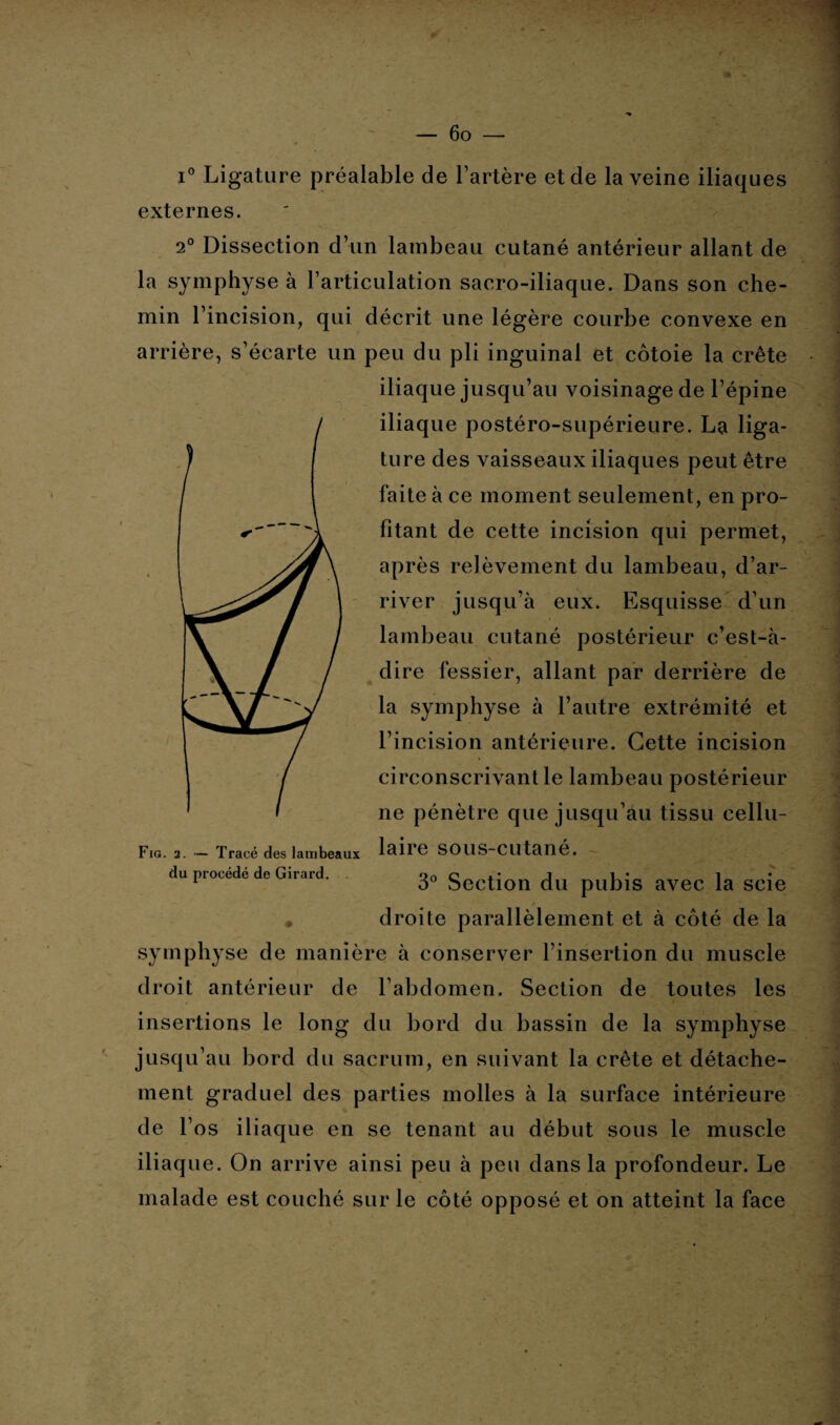 i° Ligature préalable de l’artère et de la veine iliaques externes. 2° Dissection d’un lambeau cutané antérieur allant de la symphyse à l’articulation sacro-iliaque. Dans son che¬ min l’incision, qui décrit une légère courbe convexe en arrière, s’écarte un peu du pli inguinal et côtoie la crête iliaque jusqu’au voisinage de l’épine iliaque postéro-supérieure. La liga¬ ture des vaisseaux iliaques peut être faite à ce moment seulement, en pro¬ fitant de cette incision qui permet, après relèvement du lambeau, d’ar¬ river jusqu’à eux. Esquisse d’un lambeau cutané postérieur c’est-à- dire fessier, allant par derrière de la symphyse à l’autre extrémité et l’incision antérieure. Cette incision circonscrivant le lambeau postérieur ne pénètre que jusqu’au tissu cellu- Fig. 2. — Tracé des lambeaux laire SOUS-Clltane. du procédé de Girard. or, c J î • i 1 o° Section du pubis avec la scie droite parallèlement et à côté de la symphyse de manière à conserver l’insertion du muscle droit antérieur de l’abdomen. Section de toutes les insertions le long du bord du bassin de la symphyse jusqu’au bord du sacrum, en suivant la crête et détache¬ ment graduel des parties molles à la surface intérieure de l’os iliaque en se tenant au début sous le muscle iliaque. On arrive ainsi peu à peu dans la profondeur. Le malade est couché sur le côté opposé et on atteint la face