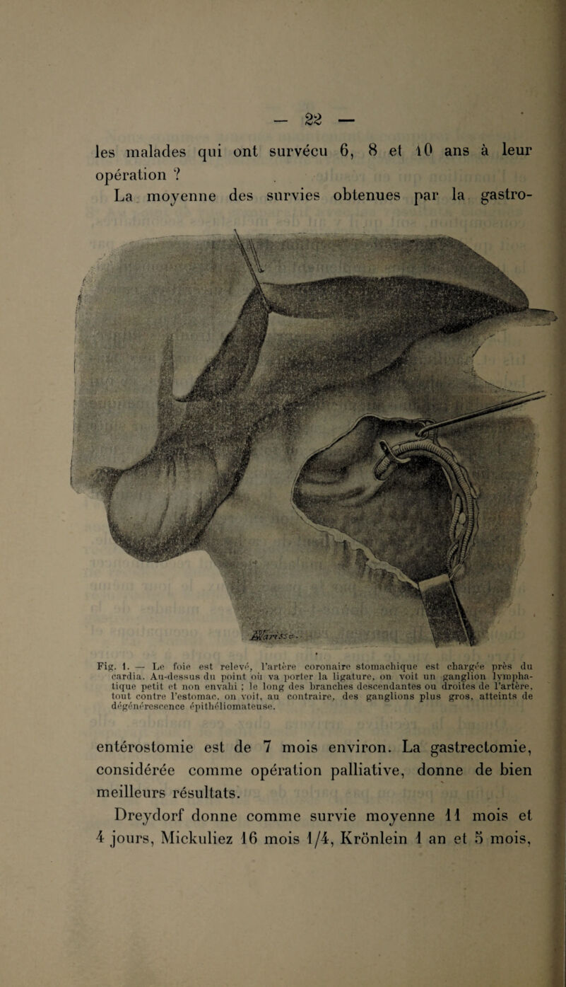 les malades qui ont survécu 6, 8 et tO ans à leur opération ? La moyenne des survies obtenues par la gastro- î ... ;à :, - .t? Fig. l. — Le foie est relevé, l’artère coronaire stomachique est chargée près du cardia. Au-dessus du point où va porter la ligature, on voit un ganglion lympha¬ tique petit et non envahi ; le long des branches descendantes ou droites de l’artère, tout contre l’estomac, on voit, au contraire, des ganglions plus gros, atteints de dégénérescence épithéliomateuse. entérostomie est de 7 mois environ. La gastrectomie, considérée comme opération palliative, donne de bien meilleurs résultats. Dreydorf donne comme survie moyenne 11 mois et 4 jours, Mickuliez 16 mois 1/4, Krônlein 1 an et 5 mois,