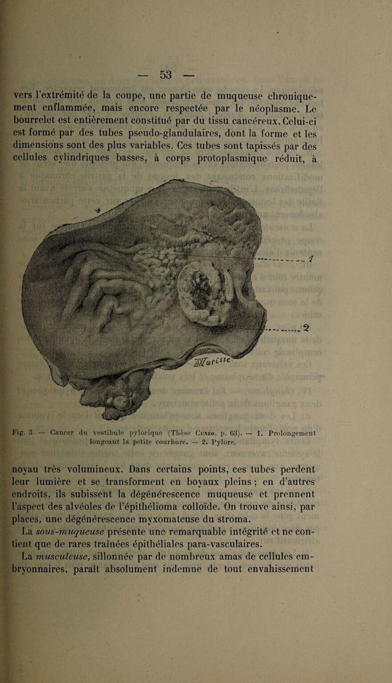 vers l’extrémité de la coupe, une partie de muqueuse chronique¬ ment enflammée, mais encore respectée par le néoplasme. Le bourrelet est entièrement constitué par du tissu cancéreux. Celui-ci est formé par des tubes pseudo-glandulaires, dont la forme et les dimensions sont des plus variables. Ces tubes sont tapissés par des cellules cylindriques basses, à corps protoplasmique réduit, à Fig. 3. — Cancer du vestibule pylorique (Thèse Cunéo. p. 03). — 1. Prolongement longeant la petite courbure. — 2. Pylore. noyau très volumineux. Dans certains points, ces tubes perdent leur lumière et se transforment en boyaux pleins ; en d’autres endroits, ils subissent la dégénérescence muqueuse et prennent l’aspect des alvéoles de l’épithélioma colloïde. On trouve ainsi, par places, une dégénérescence myxomateuse du stroma. La sous-muqueuse présente une remarquable intégrité et ne con¬ tient que de rares traînées épithéliales para-vasculaires. La musculeuse, sillonnée par de nombreux amas de cellules em¬ bryonnaires, paraît absolument indemne de tout envahissement