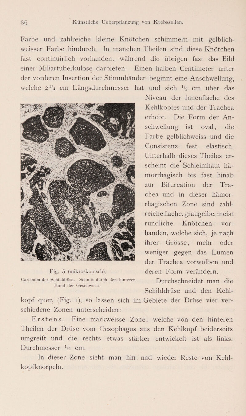 Farbe und zahlreiche kleine Knötchen schimmern mit gelblich- weisser Farbe hindurch. In manchen Theilen sind diese Knötchen fast continuirlich vorhanden, während die übrigen fast das Bild einer Miliartuberkulose darbieten. Einen halben Centimeter unter der vorderen Insertion der Stimmbänder beginnt eine Anschwellung, welche 2^4 cm Längsdurchmesser hat und sich x/2 cm über das Niveau der Innenfläche des Kehlkopfes und der Trachea erhebt. Die Form der An¬ schwellung ist oval, die Farbe gelblichweiss und die Consistenz fest elastisch. Unterhalb dieses Theiles er- 4 scheint die Schleimhaut hä¬ morrhagisch bis fast hinab zur Bifurcation der Tra¬ chea und in dieser hämor¬ rhagischen Zone sind zahl¬ reiche flache, graugelbe, meist rundliche Knötchen vor¬ handen, welche sich, je nach ihrer Grösse, mehr oder weniger gegen das Lumen der Trachea vorwölben und deren Lorm verändern. Durchschneidet man die Schilddrüse und den Kehl¬ kopf quer, (Fig. 1), so lassen sich im Gebiete der Drüse vier ver¬ schiedene Zonen unterscheiden: Erstens. Eine markweisse Zone, welche von den hinteren Theilen der Drüse vom Oesophagus aus den Kehlkopf beiderseits umgreift und die rechts etwas stärker entwickelt ist als links. Durchmesser 1/g cm. In dieser Zone sieht man hin und wieder Reste von Kehl¬ kopfknorpeln. Fig. 5 (mikroskopisch). Carcinom der Schilddrüse. Schnitt durch den hinteren Rand der Geschwulst.