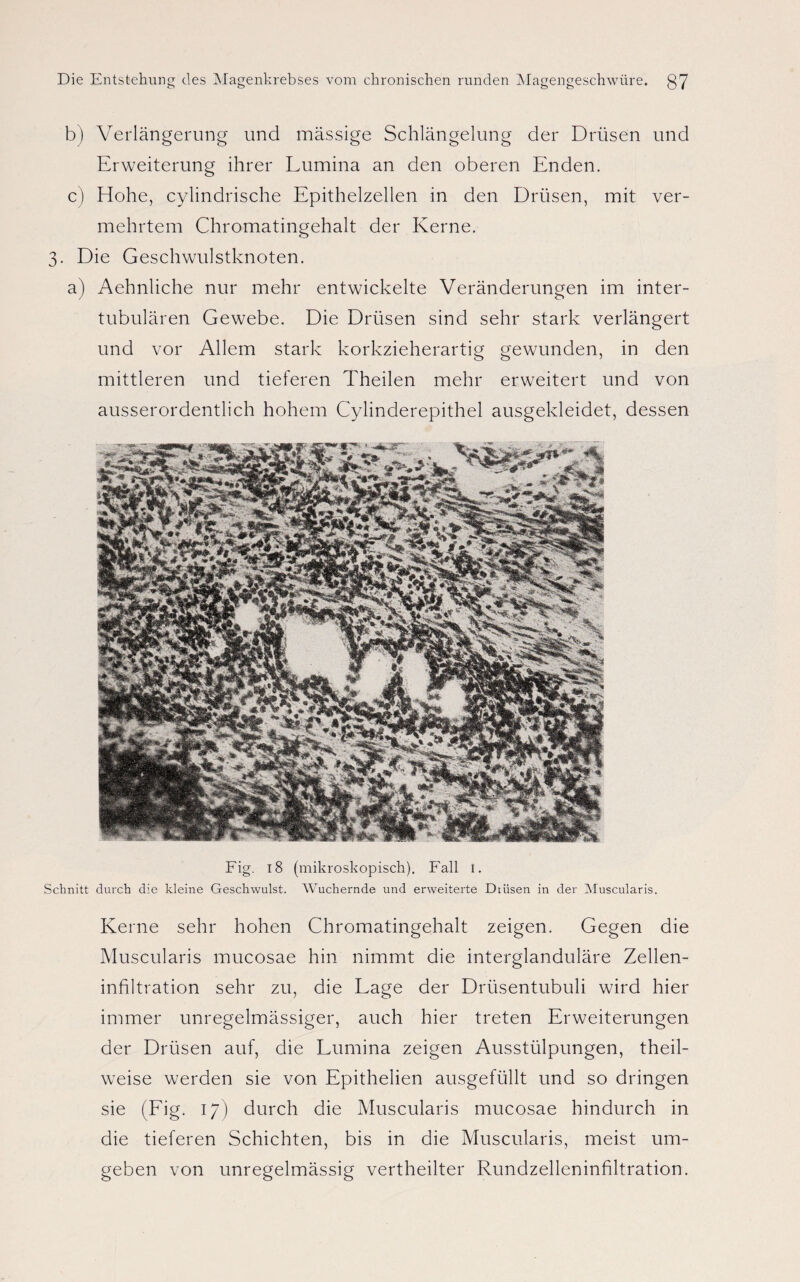 b) Verlängerung und massige Schlängelung der Drüsen und Erweiterung ihrer Lumina an den oberen Enden. c) Hohe, cylindrische Epithelzellen in den Drüsen, mit ver¬ mehrtem Chromatingehalt der Kerne. 3. Die Geschwulstknoten. a) Aehnliche nur mehr entwickelte Veränderungen im inter¬ tubulären Gewebe. Die Drüsen sind sehr stark verlängert und vor Allem stark korkzieherartig gewunden, in den mittleren und tieferen Theilen mehr erweitert und von ausserordentlich hohem Cylinderepithel ausgekleidet, dessen Fig. 18 (mikroskopisch). Fall 1. Schnitt durch die kleine Geschwulst. Wuchernde und erweiterte Dtüsen in der Muscularis. Kerne sehr hohen Chromatingehalt zeigen. Gegen die Muscularis mucosae hin nimmt die interglanduläre Zellen¬ infiltration sehr zu, die Lage der Drüsentubuli wird hier immer unregelmässiger, auch hier treten Erweiterungen der Drüsen auf, die Lumina zeigen Ausstülpungen, theil- weise werden sie von Epithelien ausgefüllt und so dringen sie (Fig. 17) durch die Muscularis mucosae hindurch in die tieferen Schichten, bis in die Muscularis, meist um¬ geben von unregelmässig vertheilter Rundzelleninfiltration.