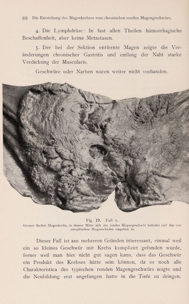 4. Die Lymphdrüse: In fast allen Theilen hämorrhagische Beschaffenheit, aber keine Metastasen. 5. Der bei der Sektion entfernte Magen zeigte die Ver¬ änderungen chronischer Gastritis und entlang der Naht starke Verdickung der Muscularis. Geschwüre oder Narben waren weiter nicht vorhanden. Fig. 19. Fall 2. Grosser flacher Magenkrebs, in dessen Mitte sich ein rundes Magengeschwür befindet und das von atrophischen Magenwänden umgeben ist. Dieser Fall ist aus mehreren Gründen interessant, einmal weil ein so kleines Geschwür mit Krebs komplizirt gefunden wurde, ferner weil man hier nicht gut sagen kann, dass das Geschwür ein Produkt des Krebses hätte sein können, da es noch alle Charakteristica des typischen runden Magengeschwürs zeigte und die Neubildung erst angefangen hatte in die Tiefe zu dringen.