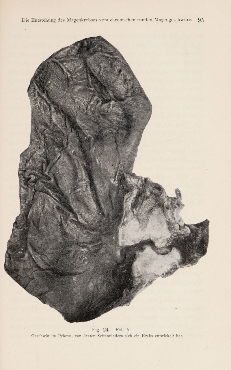 Fig. 24. Fall 6. Geschwür im Pylorus, von dessen Seitenrändern sich ein Krebs entwickelt hat.