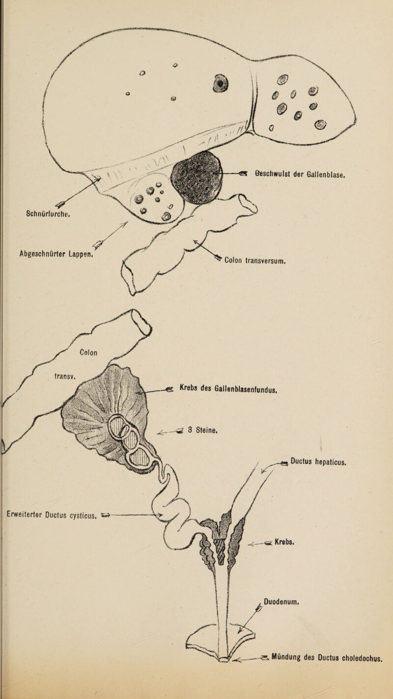 Schnürfurche. Geschwulst der Gallenblase. Colon transversum. Abgeschnürter Lappen.