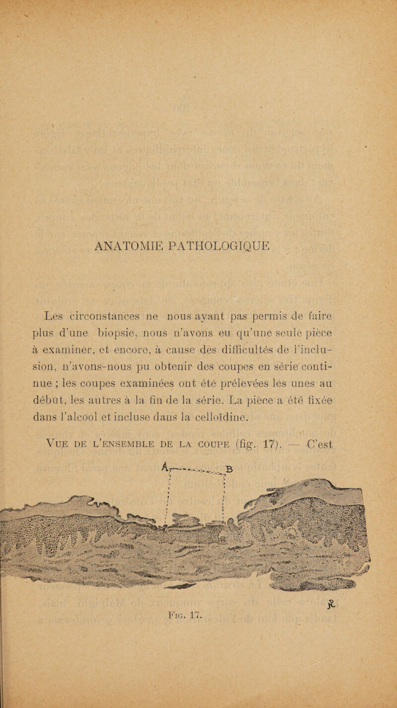 : \ ■ i ,/ J Les circonstances ne nous ayant pas permis de faire plus d'une biopsie, nous n’avons eu qu’une seule pièce à examiner, et encore, à cause des difficultés de l’inclu¬ sion, n’avons-nous pu obtenir des coupes en série conti¬ nue ; les coupes examinées ont été prélevées les unes au début, les autres à la fin de la série. La pièce a été fixée dans l'alcool et incluse dans la celloïdine. Vue de l’ensemble de la coupe (fîg.. 17). — C’est Fig. 17