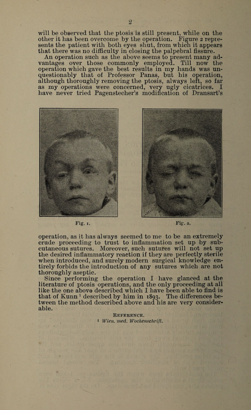 2 will be observed that the ptosis is still present, while on the other it has been overcome by the operation. Figure 2 repre¬ sents the patient with both eyes shut, from which it appears that there was no difficulty in closing the palpebral fissure. An operation such as the above seems to present many ad¬ vantages over those commonly employed. Till now the operation which gave the best results in my hands was un¬ questionably that of Professor Panas, but his operation, although thoroughly removing the ptosis, always left, so far as my operations were concerned, very ugly cicatrices. I have never tried Pagenstecher’s modification of Dransart’s Fig. 1. Fig. 2. operation, as it has always seemed to me to be an extremely crude proceeding to trust to inflammation set up by sub¬ cutaneous sutures. Moreover, such sutures will not set up the desired inflammatory reaction if they are perfectly sterile when introduced, and surely modern surgical knowledge en¬ tirely forbids the introduction of any sutures which are not thoroughly aseptic. Since performing the operation I have glanced at the literature of ptosis operations, and the only proceeding at all like the one above described which I have been able to find is that of Kunn 1 described by him in 1893. The differences be¬ tween the method described above and his are very consider¬ able. Reference. 1 Wien. med. Wochemchrift.