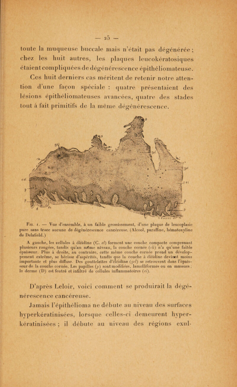 — 2 5 — toute la muqueuse buccale mais n otait pas dégénérée; chez les huit autres, les plaques leueokératosiques étaient compliquées de dégénérescence épithéliomateuse. Ces huit derniers cas méritent de retenir notre atten¬ tion d une façon spéciale : quatre présentaient des lésions épithéliomateuses avancées, quatre des stades tout a lait primitifs de la môme dégénérescence. Fig. i. — Vue d’ensemble, à un faible grossissement, d’une plaque de leucoplasie pure sans trace aucune de dégénérescence cancéreuse. (Alcool, paraffine, hématoxyline de DelaKeld.) A gauche, les cellules â éléidine (C. el) forment une couche compacte comprenant plusieurs rangées, tandis qu’au même niveau, la couche cornée (ck) n’a qu’une faible épaisseur. Plus à droite, au contraire, cette même couche cornée prend un dévelop¬ pement extrême, se hérisse d’aspérités, tandis que la couche à éléidine devient moins importante et plus diffuse. Des gouttelettes d’éléidine (<jel) se retrouvent dans l’épais¬ seur de la couche cornée. Les papilles (p) sont modifiées, lamelliformes ou en massues ; le derme (D) est feutré et infiltré de cellules inflammatoires (ci). D’ap rès Leloir, voici comment se nérescence cancéreuse. Jamais l’épithélioma ne débute au hyperkératinisées, lorsque celles-ci kératinisées ; il débute au niveau produirait la dégé- niveau des surfaces demeurent hvper- des régions exul-