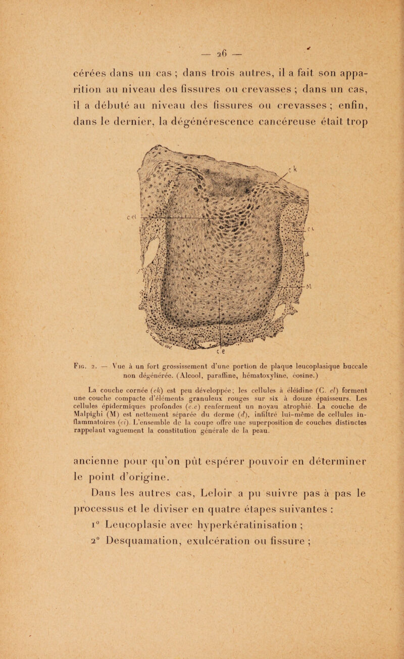 J cérées dans un cas ; dans trois autres, il a fait son appa¬ rition au niveau des fissures ou crevasses ; dans un cas, il a débuté au niveau des fissures ou crevasses ; enfin, dans le dernier, la dégénérescence cancéreuse était trop Fig. 2. — Vue à un fort grossissement d’une portion de plaque leucoplasique buccale non dégénérée. (Alcool, paraffine, hématoxyline, éosine.) La couche cornée (c/c) est peu développée; les cellules à éléidine (C. el) forment une couche compacte d’éléments granuleux rouges sur six cà douze épaisseurs. Les cellules épidermiques profondes (c.e) renferment un noyau atrophié. La couche de Malpighi (M) est nettement séparée du derme (d), infiltré lui-même de cellules in¬ flammatoires (ci). L’ensemble de la coupe offre une superposition de couches distinctes rappelant vaguement la constitution générale de la peau. ancienne pour qu on put espérer pouvoir en déterminer le point d’origine. Dans les autres cas, Leloir a pu suivre pas à pas le processus et le diviser en quatre étapes suivantes : i° Leucoplasie avec hyperkératinisation ; 2° Desquamation, exulcération ou fissure ;