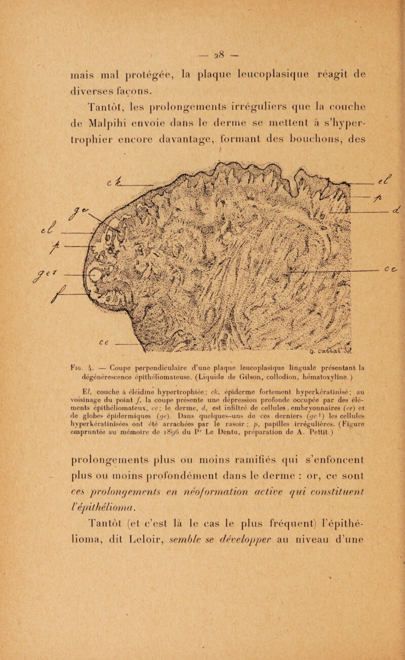 mais mal protégée, la plaque leucoplasique réagit de diverses façons. O - Tantôt, les prolongements irréguliers que la couche de MaJpihi envoie dans le derme se mettent à s’hyper- trophier encore davantage, formant des bouchons, des ! Fig. 4- — Coupe perpendiculaire d’une plaque leucoplasique linguale présentant la dégénérescence épithéliomateuse. (Liquide de Gilson,-collodion, hématoxyline.) E/, couche à éléidine hypertrophiée; ck, épiderme fortement hyperkératinisé ; au voisinage du point /, la coupe présente une dépression profonde occupée par des élé¬ ments épithéliomateux, ce; le derme, d, est infiltré de cellules , embryonnaires (ce) et de globes épidermiques (f]e)- Dans quelques-uns de ces derniers (je1) les cellules hyperkératinisées ont été arrachées par le rasoir ; p, papilles irrégulières. (Figure empruntée au mémoire de 1896 du Pr Le Denlu, préparation de A. Pettit.) prolongements plus ou moins ramifiés qui s’enfoncent plus ou moins profondément dans le derme : or, ce sont ces prolongements en néoformation active qui constituent lépithélioma. Tantôt (et c’est là le cas le plus fréquent) l’épithé- lioma, dit Leloir, semble se développer au niveau d’une