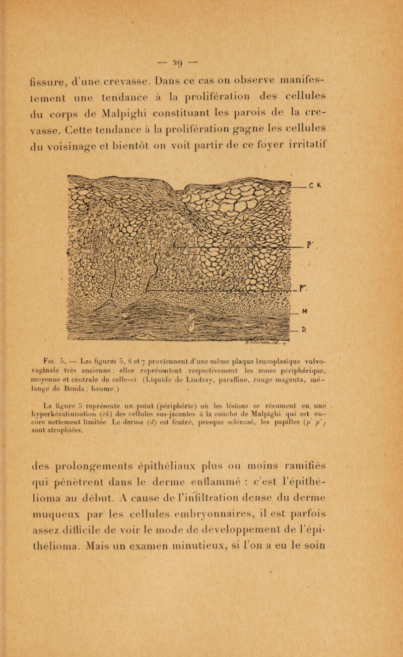 fissure, d une crevasse. Dans ce cas on observe manifes¬ tement une tendance à la prolifération des cellules du corps de Malpighi constituant les parois de la (‘rê¬ vasse. Cette tendance à la prolifération gagne les cellules du voisinage et bientôt on voit partir de ce foyer irritatif Kig. 5. — Les figures 5, 6 et 7 proviennent d’une même plaque leucoplasique vulvo- vaginale très ancienne ; elles représentent respectivement les zones périphérique, moyenne et centrale de celle-ci. (Liquide de Lindsay, paraffine, rouge magenta, mé¬ lange de Benda ; baume.) La figure 5 représente un point (périphérie) où les lésions se résument en une hyperkératinisation (rA) des cellules sus-jacentes à la couche de Malpighi qui est en¬ core nettement limitée. Le derme (tl) est feutré, presque sclérosé, les papilles (p ja) sont atrophiées. des prolongements épithéliaux plus ou moins ramifiés qui pénètrent dans le derme enflammé : c’est l’épithé- lioma au début. A cause de l’infiltration dense du derme muqueux par les cellules embryonnaires, il est parfois assez difficile de voir le mode de développement de l’épi- thélioma. Mais un examen minutieux, si l’on a eu le soin