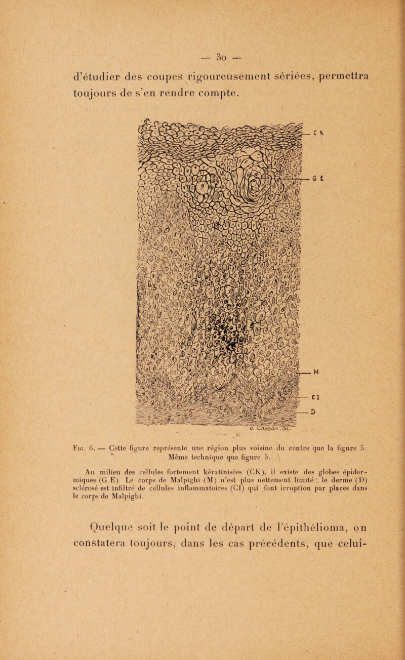 d’étudier des coupes rigoureusement sériées, permettra toujours de s’en rendre compte. Même technique que figure 5. Au milieu des cellules fortement kératinisées (Civ), il existe des globes épider¬ miques (G.E). Le corps de Malpighi (M) n’est plus nettement limité ; le derme (D) sclérosé est infiltré de cellules inflammatoires (Cf) qui font irruption par places dans le corps de Malpighi. Quelque soit le point de départ de l’épithélioma, on constatera toujours, dans les cas précédents, que celui-