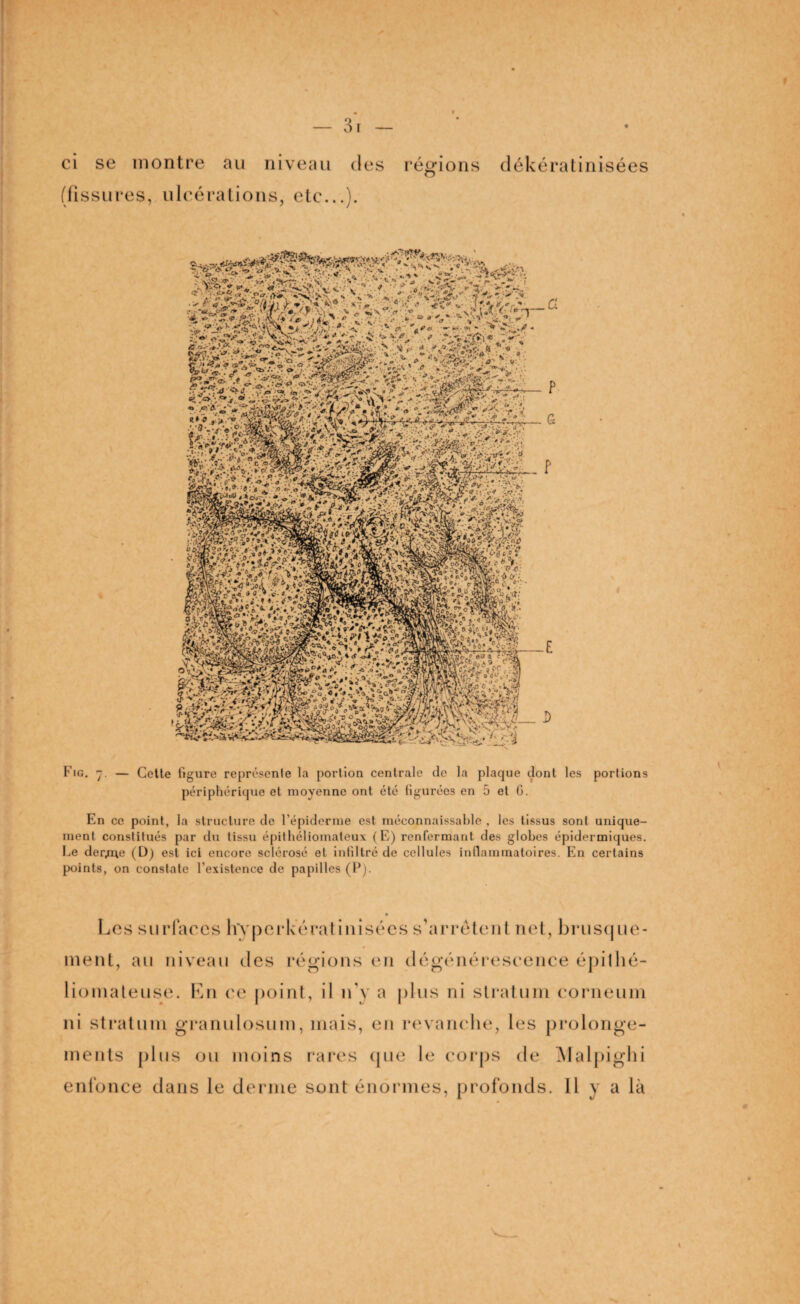 3 r ci se montre au niveau des (fissures, ulcérations, etc...). régions dékératinisées r ■r#r# ■yjoi) ,.»0v •Vf V(JOlaC H*? ?.. i.«*V c.o.PO- 58P*e BgkWv? KSiBtv' es » ' rKa^ï'jfé «?? • .W Kig. -j . — Cette figure représente la portion centrale de la plaque dont les portions périphérique et moyenne ont été figurées en 5 et G. En ce point, la structure de l’épiderme est méconnaissable , les tissus sont unique¬ ment constitués par du tissu épithéliomateux (E) renfermant des globes épidermiques. Ee der/ue (U) est ici encore sclérosé et infiltré de cellules inflammatoires. En certains points, on constate l’existence de papilles (P). \ Les surfaces hyperkérat misées s'arrêtent net, brusque¬ ment, au niveau des régions en dégénérescence épitlié- liomateuse. En ee point, il n’y a plus ni stratum corneum ni stratum granulosum, mais, en revanche, les prolonge¬ ments plus ou moins rares que le corps de Malpighi enfonce dans le derme sont énormes, profonds. Il y a là -