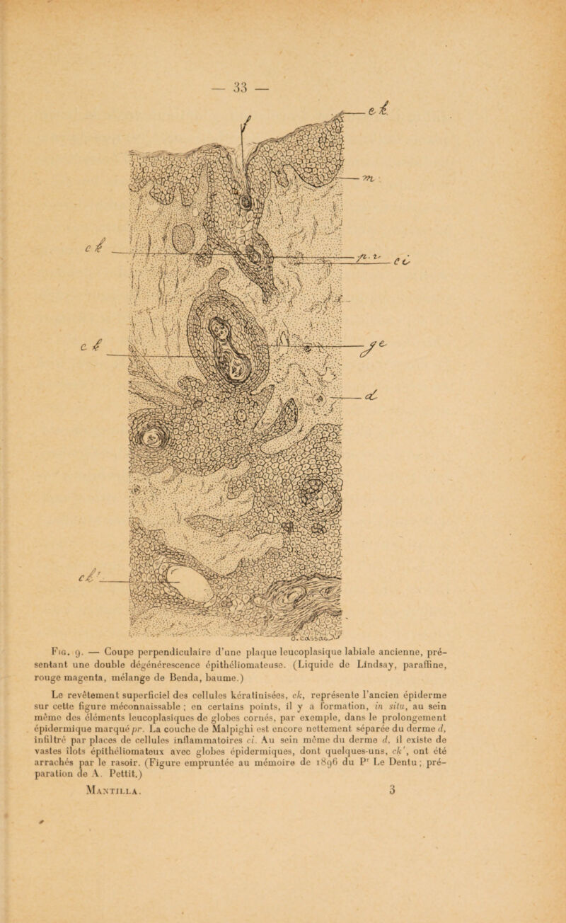 Fig. 9. — Coupe perpendiculaire d’une plaque leucoplasique labiale ancienne, pré¬ sentant une double dégénérescence épithéliomateuso. (Liquide de Lindsay, paraffine, rouge magenta, mélange de Benda, baume.) Le revêtement superficiel des cellules kératinisées, c/c, représente l’ancien épiderme sur cette figure méconnaissable ; en certains points, il y a formation, in situ, au sein même des éléments leucoplasiqucs de globes cornés, par exemple, dans le prolongement épidermique marquépr. La couche de Malpighi est encore nettement séparée du derme d, infiltré par places de cellules inflammatoires ci. Au sein même du derme d, il existe de vastes îlots épithéliomateux avec globes épidermiques, dont quelques-uns, ck', ont été arrachés par le rasoir. (Figure empruntée au mémoire de 1896 du Pr Le Dentu ; pré¬ paration de A. Pettit.) Mantjlla. 3 *