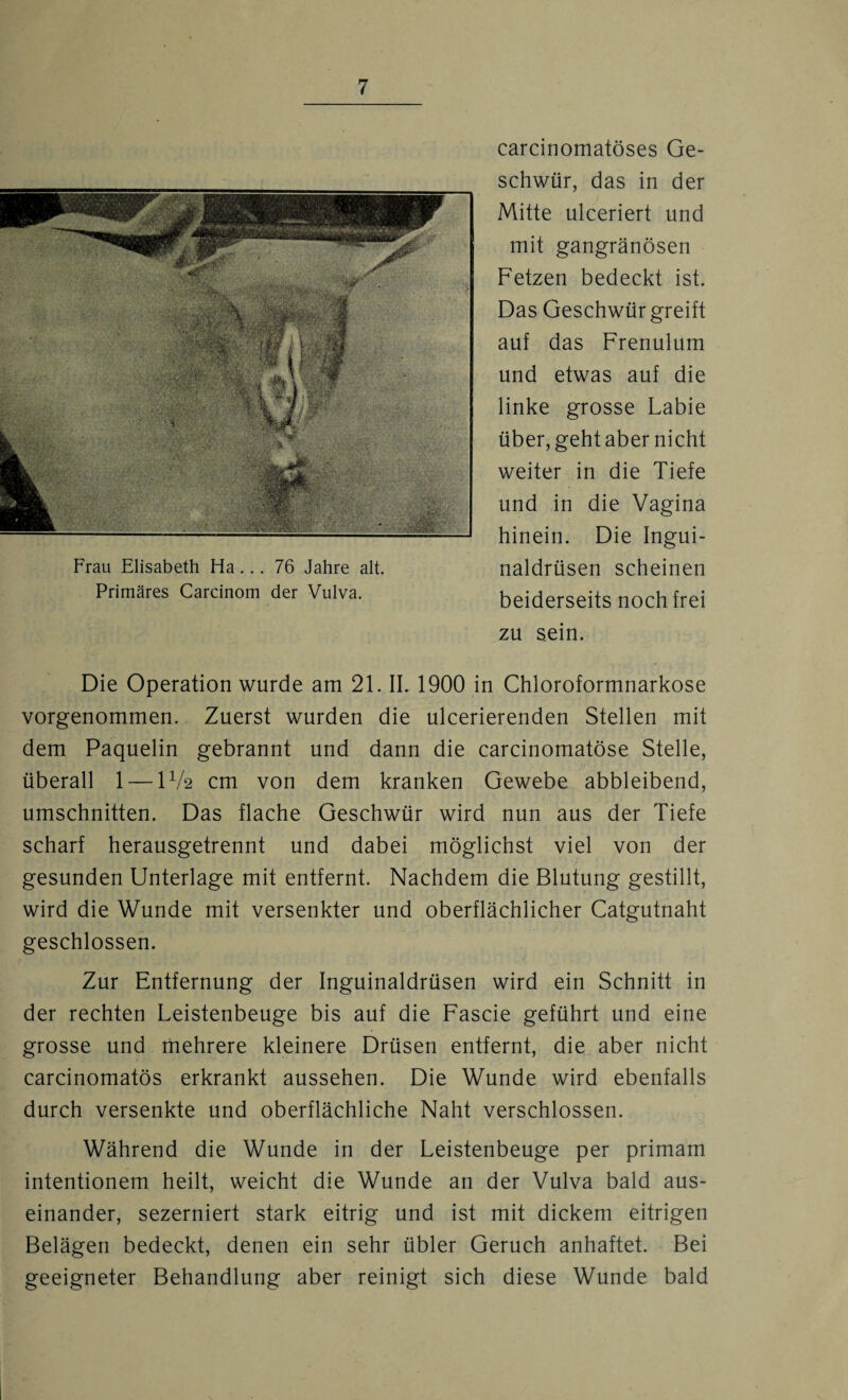 carcinomatöses Ge¬ schwür, das in der Mitte ulceriert und mit gangränösen Fetzen bedeckt ist. Das Geschwür greift auf das Frenulum und etwas auf die linke grosse Labie über, geht aber nicht weiter in die Tiefe und in die Vagina hinein. Die Ingui¬ naldrüsen scheinen beiderseits noch frei zu sein. Die Operation wurde am 21. IL 1900 in Chloroformnarkose vorgenommen. Zuerst wurden die ulcerierenden Stellen mit dem Paquelin gebrannt und dann die carcinomatöse Stelle, überall 1 — IV2 cm von dem kranken Gewebe abbleibend, Umschnitten. Das flache Geschwür wird nun aus der Tiefe scharf herausgetrennt und dabei möglichst viel von der gesunden Unterlage mit entfernt. Nachdem die Blutung gestillt, wird die Wunde mit versenkter und oberflächlicher Catgutnaht geschlossen. Zur Entfernung der Inguinaldrüsen wird ein Schnitt in der rechten Leistenbeuge bis auf die Fascie geführt und eine grosse und mehrere kleinere Drüsen entfernt, die aber nicht carcinomatös erkrankt aussehen. Die Wunde wird ebenfalls durch versenkte und oberflächliche Naht verschlossen. Während die Wunde in der Leistenbeuge per primam intentionem heilt, weicht die Wunde an der Vulva bald aus¬ einander, sezerniert stark eitrig und ist mit dickem eitrigen Belägen bedeckt, denen ein sehr übler Geruch anhaftet. Bei geeigneter Behandlung aber reinigt sich diese Wunde bald Frau Elisabeth Ha... 76 Jahre alt. Primäres Carcinom der Vulva.