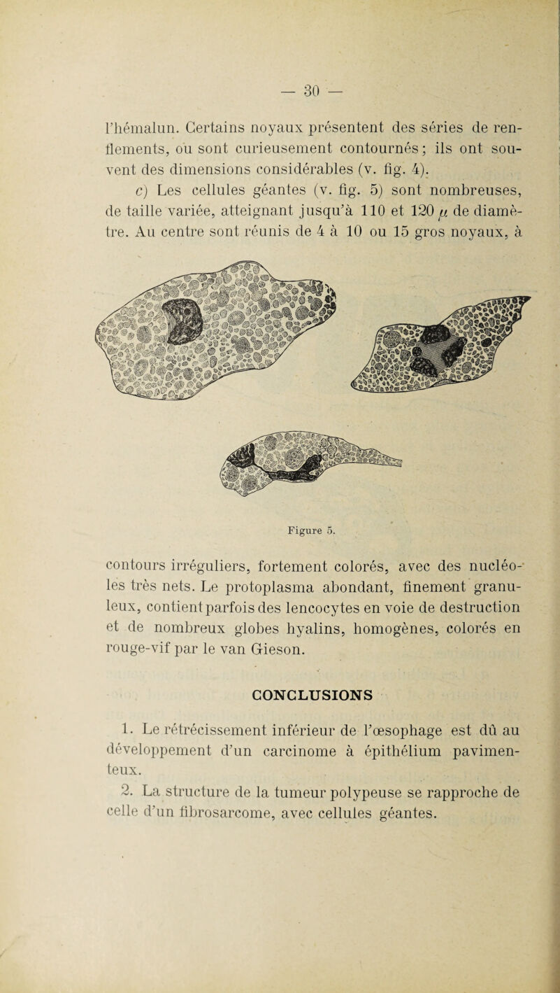 l’hémalun. Certains noyaux présentent des séries de ren¬ flements, ou sont curieusement contournés ; ils ont sou¬ vent des dimensions considérables (v. fig. 4). c) Les cellules géantes (v. fig. 5) sont nombreuses, de taille variée, atteignant jusqu'à 110 et 120 « de diamè¬ tre. Au centre sont réunis de 4 à 10 ou 15 gros noyaux, à m Wx* M Figure 5. contours irréguliers, fortement colorés, avec des nucléo¬ les très nets. Le protoplasma abondant, finement granu¬ leux, contient parfois des lencocytes en voie de destruction et de nombreux globes hyalins, homogènes, colorés en rouge-vif par le van Gieson. CONCLUSIONS 1. Le rétrécissement inférieur de Fœsophage est dûau développement d'un carcinome à épithélium pavimen- teux. 2. La structure de la tumeur polypeuse se rapproche de celle d’un fibrosarcome, avec cellules géantes.