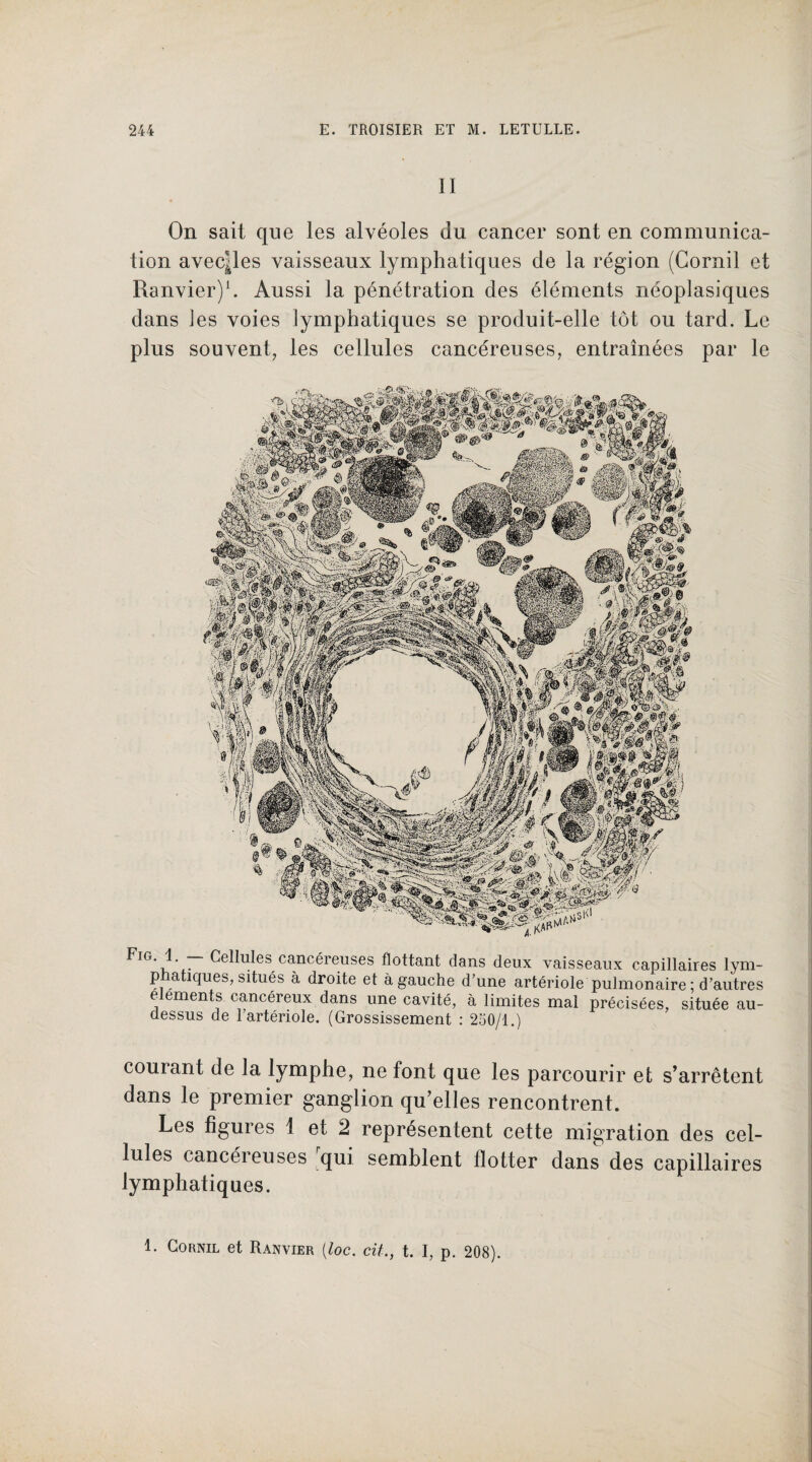 II On sait que les alvéoles du cancer sont en communica¬ tion avecpes vaisseaux lymphatiques de la région (Gomil et Ranvier)1. Aussi la pénétration des éléments néoplasiques dans les voies lymphatiques se produit-elle tôt ou tard. Le plus souvent, les cellules cancéreuses, entraînées par le ^IG'-u V Cellules cancéreuses flottant dans deux vaisseaux capillaires lym- p a îques, situés à droite et à gauche d’une artériole pulmonaire; d’autres éléments cancéreux dans une cavité, à limites mal précisées, située au- dessus de l’artériole. (Grossissement : 250/1.) courant de la lymphe, ne font que les parcourir et s’arrêtent dans le premier ganglion qu’elles rencontrent. Les figures 1 et 2 représentent cette migration des cel¬ lules cancéreuses qui semblent flotter dans des capillaires lymphatiques. 1. Cornil et Ranvier (loc. cit., t. I, p. 208).