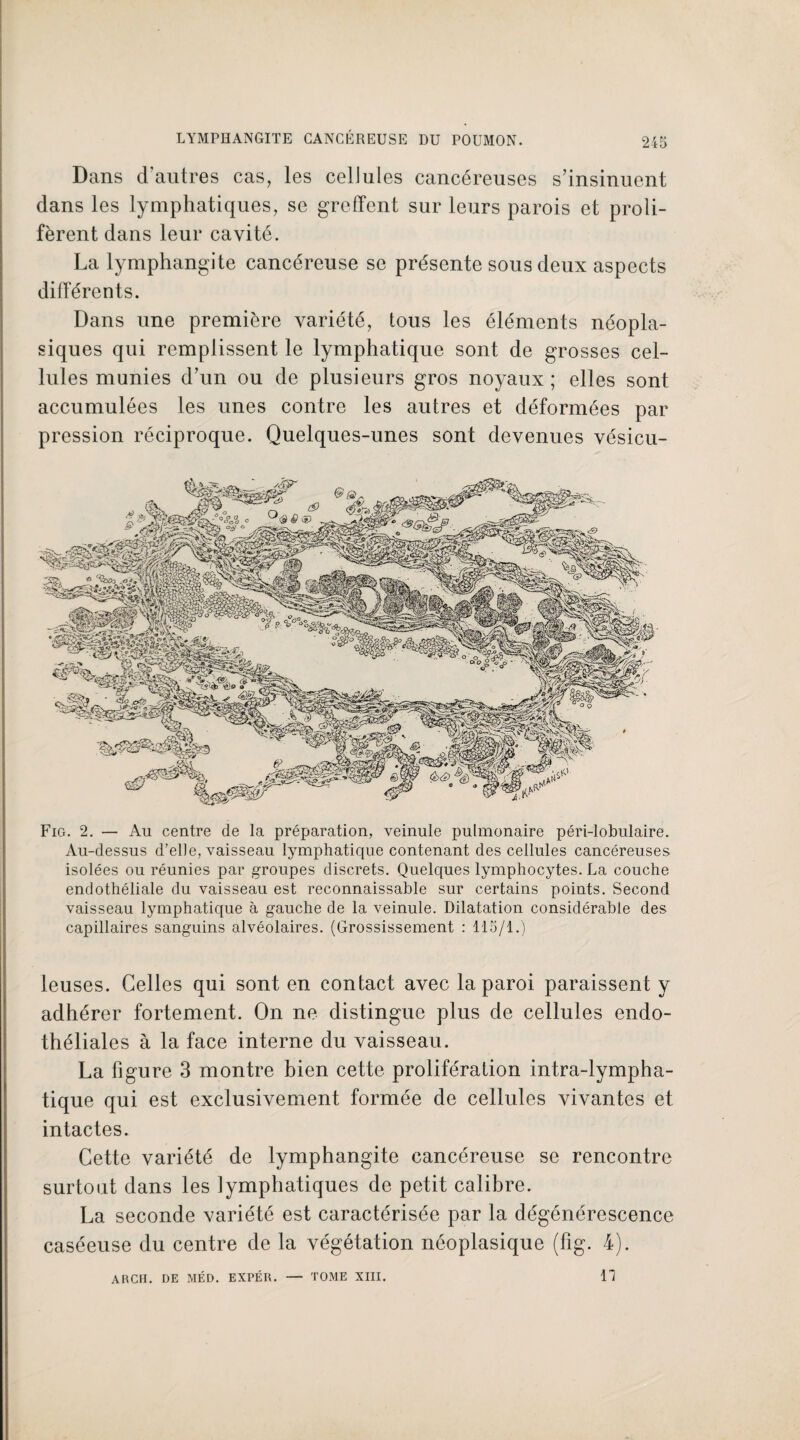 Dans d'autres cas, les cellules cancéreuses s’insinuent dans les lymphatiques, se greffent sur leurs parois et proli¬ fèrent dans leur cavité. La lymphangite cancéreuse se présente sous deux aspects différents. Dans une première variété, tous les éléments néopla¬ siques qui remplissent le lymphatique sont de grosses cel¬ lules munies d’un ou de plusieurs gros noyaux ; elles sont accumulées les unes contre les autres et déformées par pression réciproque. Quelques-unes sont devenues vésicu- Fig. 2. — Au centre de la préparation, veinule pulmonaire péri-lobulaire. Au-dessus d’elle, vaisseau lymphatique contenant des cellules cancéreuses isolées ou réunies par groupes discrets. Quelques lymphocytes. La couche endothéliale du vaisseau est reconnaissable sur certains points. Second vaisseau lymphatique à gauche de la veinule. Dilatation considérable des capillaires sanguins alvéolaires. (Grossissement : 115/1.) leuses. Celles qui sont en contact avec la paroi paraissent y adhérer fortement. On ne distingue plus de cellules endo¬ théliales à la face interne du vaisseau. La figure 3 montre bien cette prolifération intra-lympha- tique qui est exclusivement formée de cellules vivantes et intactes. Cette variété de lymphangite cancéreuse se rencontre surtout dans les lymphatiques de petit calibre. La seconde variété est caractérisée par la dégénérescence caséeuse du centre de la végétation néoplasique (fig. 4). ARCH. DE MÉD. EXPÉR. — TOME XIII. n