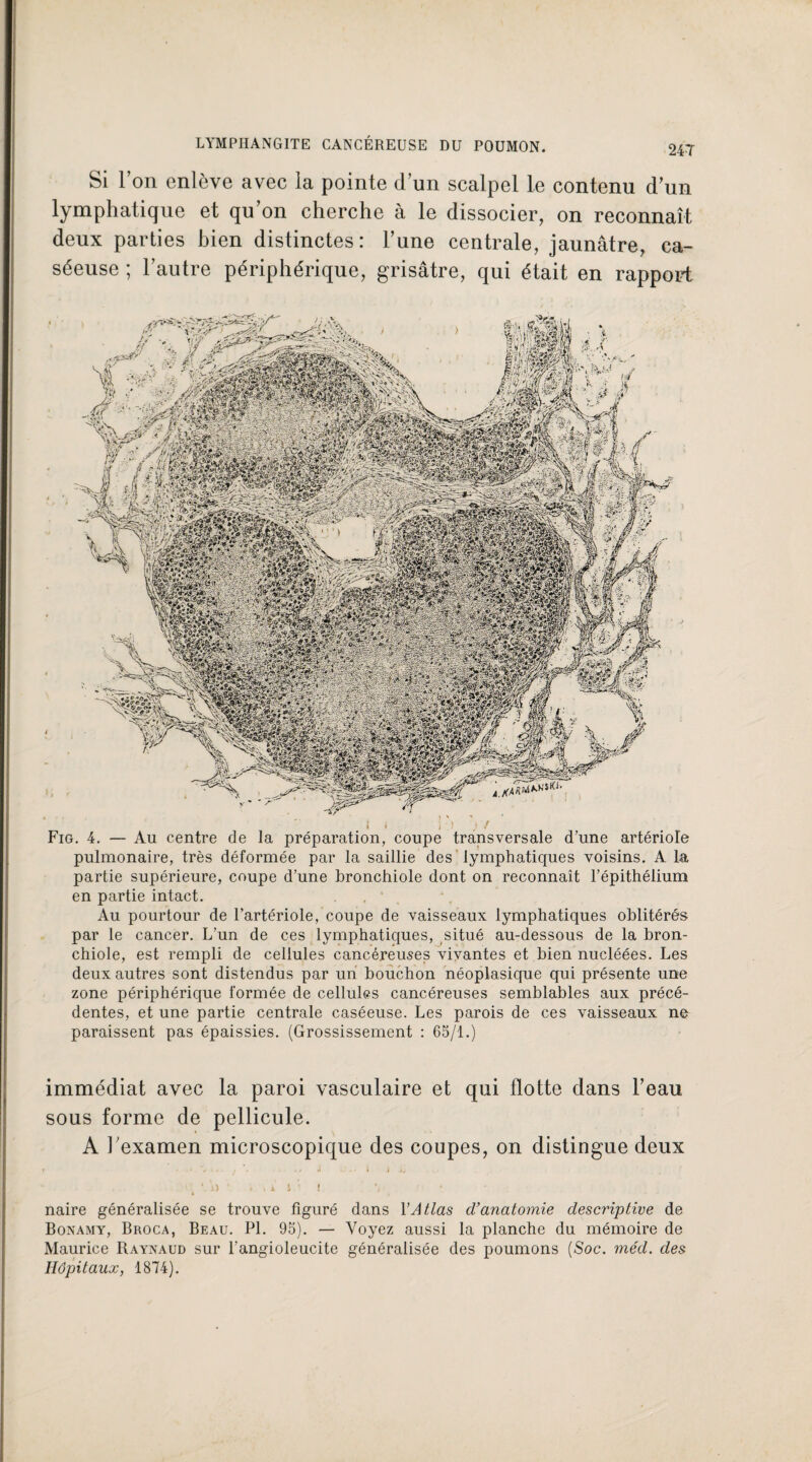 Si 1 on enlève avec la pointe d’un scalpel le contenu d’un lymphatique et qu’on cherche à le dissocier, on reconnaît deux parties bien distinctes: l’une centrale, jaunâtre, ca¬ séeuse ; l’autre périphérique, grisâtre, qui était en rapport * » j ; ? Fig. 4. — Au centre de la préparation, coupe transversale d’une artériole pulmonaire, très déformée par la saillie des lymphatiques voisins. A la partie supérieure, coupe d’une bronchiole dont on reconnaît l’épithélium en partie intact. . Au pourtour de l’artériole, coupe de vaisseaux lymphatiques oblitérés par le cancer. L’un de ces lymphatiques, situé au-dessous de la bron¬ chiole, est rempli de cellules cancéreuses vivantes et bien nucléées. Les deux autres sont distendus par un bouchon néoplasique qui présente une zone périphérique formée de cellules cancéreuses semblables aux précé¬ dentes, et une partie centrale caséeuse. Les parois de ces vaisseaux ne paraissent pas épaissies. (Grossissement : 65/1.) immédiat avec la paroi vasculaire et qui flotte dans l’eau sous forme de pellicule. A l’examen microscopique des coupes, on distingue deux i . i ï • •. • l .i i. 4 \) • ; A* i • 1 h naire généralisée se trouve figuré dans Y Atlas d’anatomie descriptive de Bonamy, Broca, Beau. PL 95). — Voyez aussi la planche du mémoire de Maurice Rayxaud sur l’angioleucite généralisée des poumons (Soc. méd. des Hôpitaux, 1874).