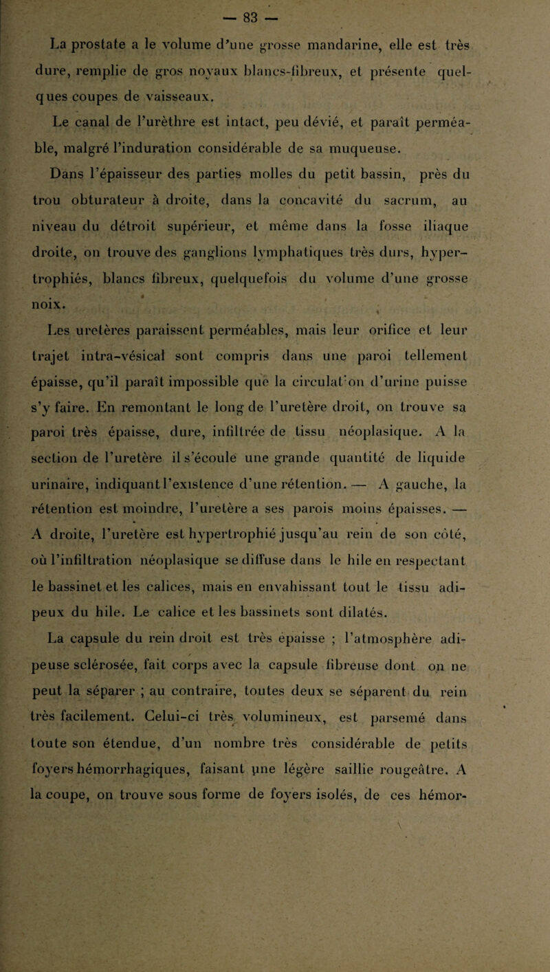 La prostate a le volume d’une grosse mandarine, elle est très dure, remplie de gros noyaux blancs-fibreux, et présente quel¬ ques coupes de vaisseaux. Le canal de l’urèthre est intact, peu dévié, et paraît perméa¬ ble, malgré l’induration considérable de sa muqueuse. Dans l’épaisseur des parties molles du petit bassin, près du trou obturateur à droite, dans la concavité du sacrum, au niveau du détroit supérieur, et même dans la fosse iliaque droite, on trouve des ganglions lymphatiques très durs, hyper¬ trophiés, blancs fibreux, quelquefois du volume d’une grosse • * , j. ■ noix. Les uretères paraissent perméables, mais leur orifice et leur trajet intra-vésical sont compris dans une paroi tellement épaisse, qu’il paraît impossible que la circulation d’urine puisse s’y faire. En remontant le long de l’uretère droit, on trouve sa paroi très épaisse, dure, infiltrée de tissu néoplasique. A la section de l’uretère il s’écoule une grande quantité de liquide urinaire, indiquant l’existence d’une rétention.— A gauche, la rétention est moindre, l’uretère a ses parois moins épaisses. — A droite, l’uretère est hypertrophié jusqu’au rein de son côté, où l’infiltration néoplasique se diffuse dans le hile en respectant le bassinet et les calices, mais en envahissant tout le tissu adi¬ peux du hile. Le calice et les bassinets sont dilatés. La capsule du rein droit est très épaisse ; l’atmosphère adi¬ peuse sclérosée, fait corps avec la capsule fibreuse dont on ne peut la séparer ; au contraire, toutes deux se séparent du rein très facilement. Celui-ci très volumineux, est parsemé dans toute son étendue, d’un nombre très considérable de petits foyers hémorrhagiques, faisant yne légère saillie rougeâtre. A la coupe, on trouve sous forme de foyers isolés, de ces hémor-