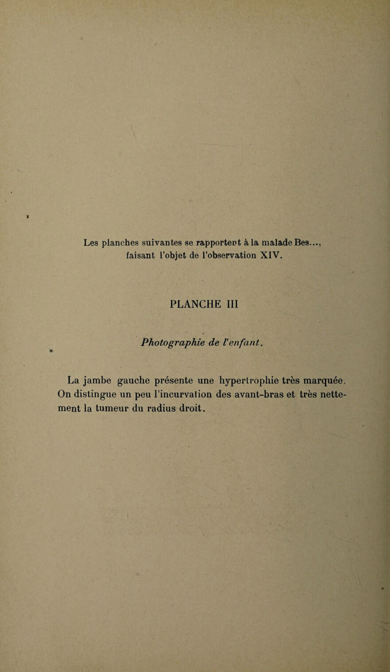 Les planches suivantes se rapportent à la malade Bes..., faisant l’objet de l’observation XIV. PLANCHE III Photographie de Venfant. La jambe gauche présente une hypertrophie très marquée, On distingue un peu l’incurvation des avant-bras et très nette¬ ment la tumeur du radius droit.