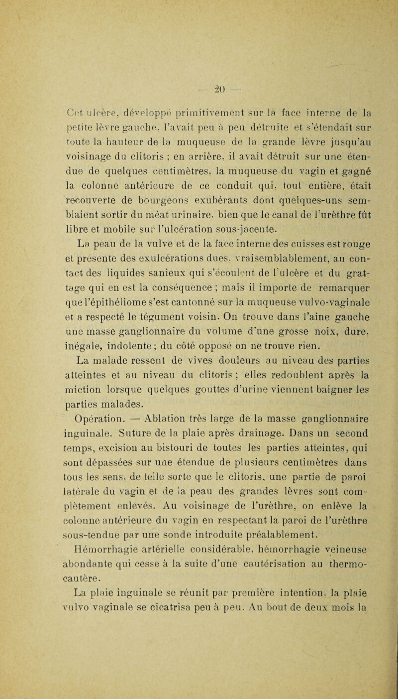 Cet ulcère, développé primitivement sur la face interne de la petite lèvre gauche, l’avait peu à peu détruite et s’étendait sur toute la hauteur de la muqueuse de la grande lèvre jusqu’au voisinage du clitoris ; en arrière, il avait détruit sur une éten¬ due de quelques centimètres, la muqueuse du vagin et gagné la colonne antérieure de ce conduit qui. tout entière, était recouverte de bourgeons exubérants dont quelques-uns sem¬ blaient sortir du méat urinaire, bien que le canal de l'urèthre fût libre et mobile sur l’ulcération sous-jacente. La peau de la vulve et de la face interne des cuisses est rouge et présente des exulcérations dues, vraisemblablement, au con¬ tact des liquides sanieux qui s’écoulent de l'ulcère et du grat¬ tage qui en est la conséquence ; mais il importe de remarquer que l’épithéliome s’est cantonné sur la muqueuse vulvo-vaginale et a respecté le tégument voisin. On trouve dans l’aine gauche une masse ganglionnaire du volume d'une grosse noix, dure, inégale, indolente; du côté opposé on ne trouve rien. La malade ressent de vives douleurs au niveau des parties atteintes et au niveau du clitoris ; elles redoublent après la miction lorsque quelques gouttes d’urine viennent baigner les parties malades. Opération. — Ablation très large de la masse ganglionnaire inguinale. Suture de la plaie après drainage. Dans un second temps, excision au bistouri de toutes les parties atteintes, qui sont dépassées sur une étendue de plusieurs centimètres dans tous les sens, de telle sorte que le clitoris, une partie de paroi latérale du vagin et de la peau des grandes lèvres sont com¬ plètement enlevés. Au voisinage de l’urèthre, on enlève la colonne antérieure du vagin en respectant la paroi de l’urèthre sous-tendue par une sonde introduite préalablement. Hémorrhagie artérielle considérable, hémorrhagie veineuse abondante qui cesse à la suite d’une cautérisation au thermo¬ cautère. La plaie inguinale se réunit par première intention, la plaie vulvo vaginale se cicatrisa peu à peu. Au bout de deux mois la