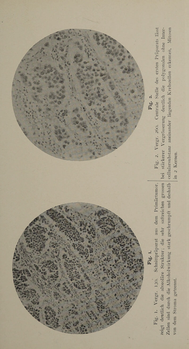 - 'frmm ■ * 1 »* , - i * Ä. -;>*.} “5?: ^r; * v ** * #■ $» ^ ® x * ,?x h\* l a * . * *' .m ...-ä y VV Ar *• *** > ^ v, %' Ci - ... » „VJ * .... jk , «H s N #* •r * ,* ■ ■'<■■ _aJ£sö, Jt .. - ^ *. * * e *. ■*• -■v ■' ’ ' * ^ W% V er %#; # / * ■%> ■ ~L :% li m % X * «* ~ :,. #\ * \ **V j£» # If4’ Ä * *. - V W- T’ f: I * ' \ ■% ■ <• '.’* ■» V :> iV., . ‘ *?' ^ * fc „ o jj* •* ;; « : *V ® ■ V ... ;r * *' S*>. >.?*•■  . * *V . ’S* •% . 4, * IK ; #■' V $?*■ ■ . « ^ ,r »i* i ■ s*. * V V» «fe < %. # •?-■ ' * ' ~ä * , ** %■ - , # ’ » | * -m V -- V.V« K * . ** % V 4S . V* V s - \ >50 4 i*»5* * * #« ß ifl.;# * 4 ’ v ^** l % * V »• i < % S?§ if ''r;K *. ■ &■' >*■. ’>j + »vl w**t 4»* * «■ X * » « ^ ' V f fc« “* t Ä * * ^ ^ 1 '^. *■- “ ** m :% 0%st Wl,$r % ■ «8* v* V ■V> A * bi) t»H pt, ;:■ s;äA vv^Sr : <^;V> ^ %' IW; ÖLaifc * *’ * ^ > A.’ bß fe Fig. 1. Vergr. 130. Schnittpräparat aus dem Primärtumor, Fig\ 2. Vergr. 260. Centrale Stelle des ersten Präparats lässt zeigt deutlich die alveoläre Struktur; die sehr saftreichen grossen bei stärkerer Vergrösserung deutlich die polygonalen ohne Inter- Zellen sind durch die Alkohol Wirkung stark geschrumpft und deshalb cellularsubstanz aneinander liegenden Krebszellen erkennen. Mitosen von dem Stroma getrennt. in 2 Kernen.