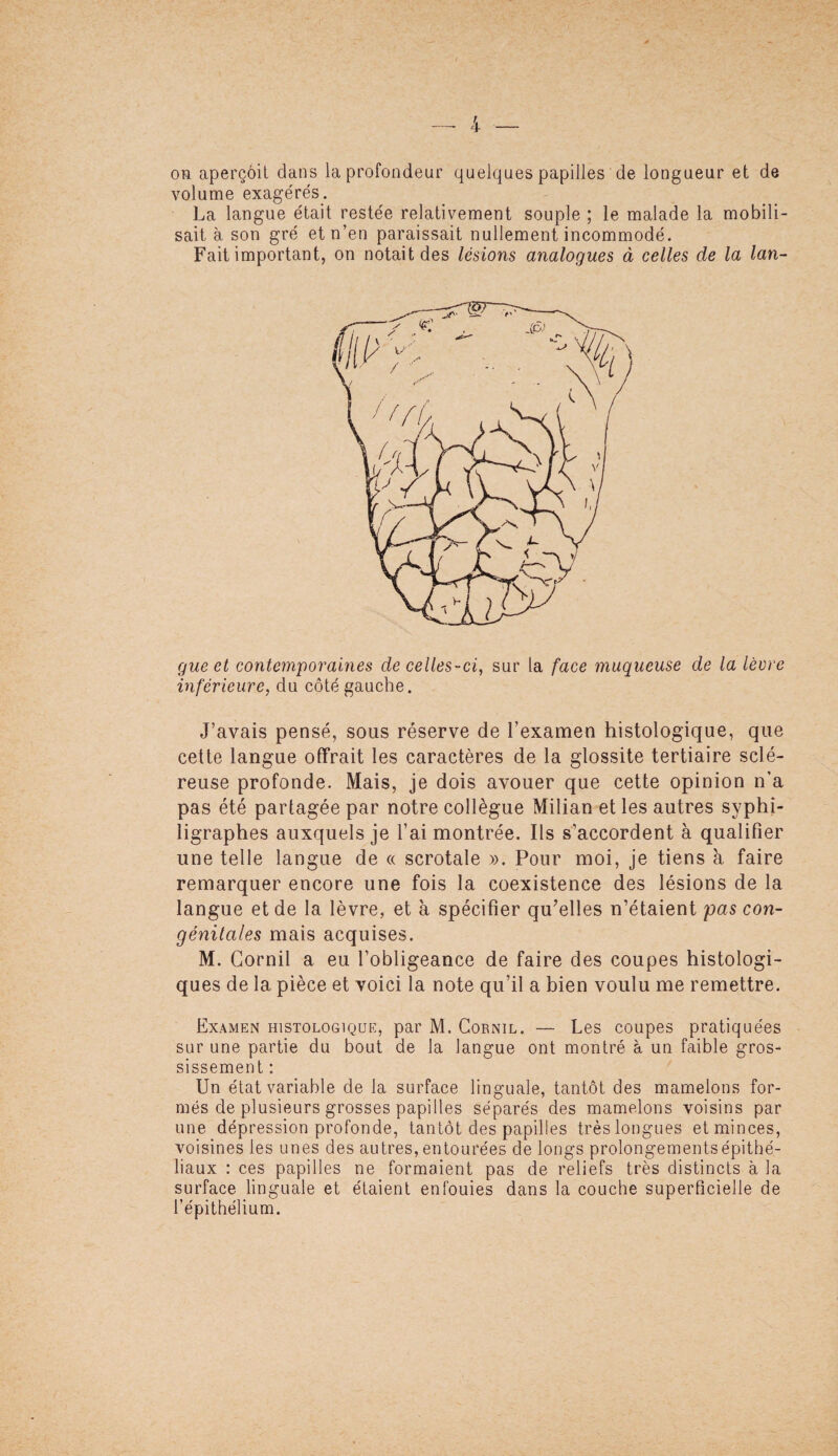 on aperçoit dans la profondeur quelques papilles de longueur et de volume exagérés. La langue était restée relativement souple ; le malade la mobili¬ sait à son gré et n’en paraissait nullement incommodé. Fait important, on notait des lésions analogues à celles de la lan¬ gue et contemporaines de celles-ci, sur la face muqueuse de la lèvre inférieure, du côté gauche. J’avais pensé, sous réserve de l’examen histologique, que cette langue offrait les caractères de la glossite tertiaire sclé¬ reuse profonde. Mais, je dois avouer que cette opinion n’a pas été partagée par notre collègue Milian et les autres syphi- ligraphes auxquels je l’ai montrée. Ils s’accordent à qualifier une telle langue de « scrotale ». Pour moi, je tiens à faire remarquer encore une fois la coexistence des lésions de la langue et de la lèvre, et à spécifier qu’elles n’étaient pas con¬ génitales mais acquises. M. Gornil a eu l’obligeance de faire des coupes histologi¬ ques de la pièce et voici la note qu’il a bien voulu me remettre. Examen histologique, par M. Cornil. — Les coupes pratiquées sur une partie du bout de la langue ont montré à un faible gros¬ sissement : Un état variable de la surface linguale, tantôt des mamelons for¬ més de plusieurs grosses papilles séparés des mamelons voisins par une dépression profonde, tantôt des papilles très longues et minces, voisines les unes des autres, entourées de longs prolongements épithé- liaux : ces papilles ne formaient pas de reliefs très distincts à la surface linguale et étaient enfouies dans la couche superficielle de l’épithélium.