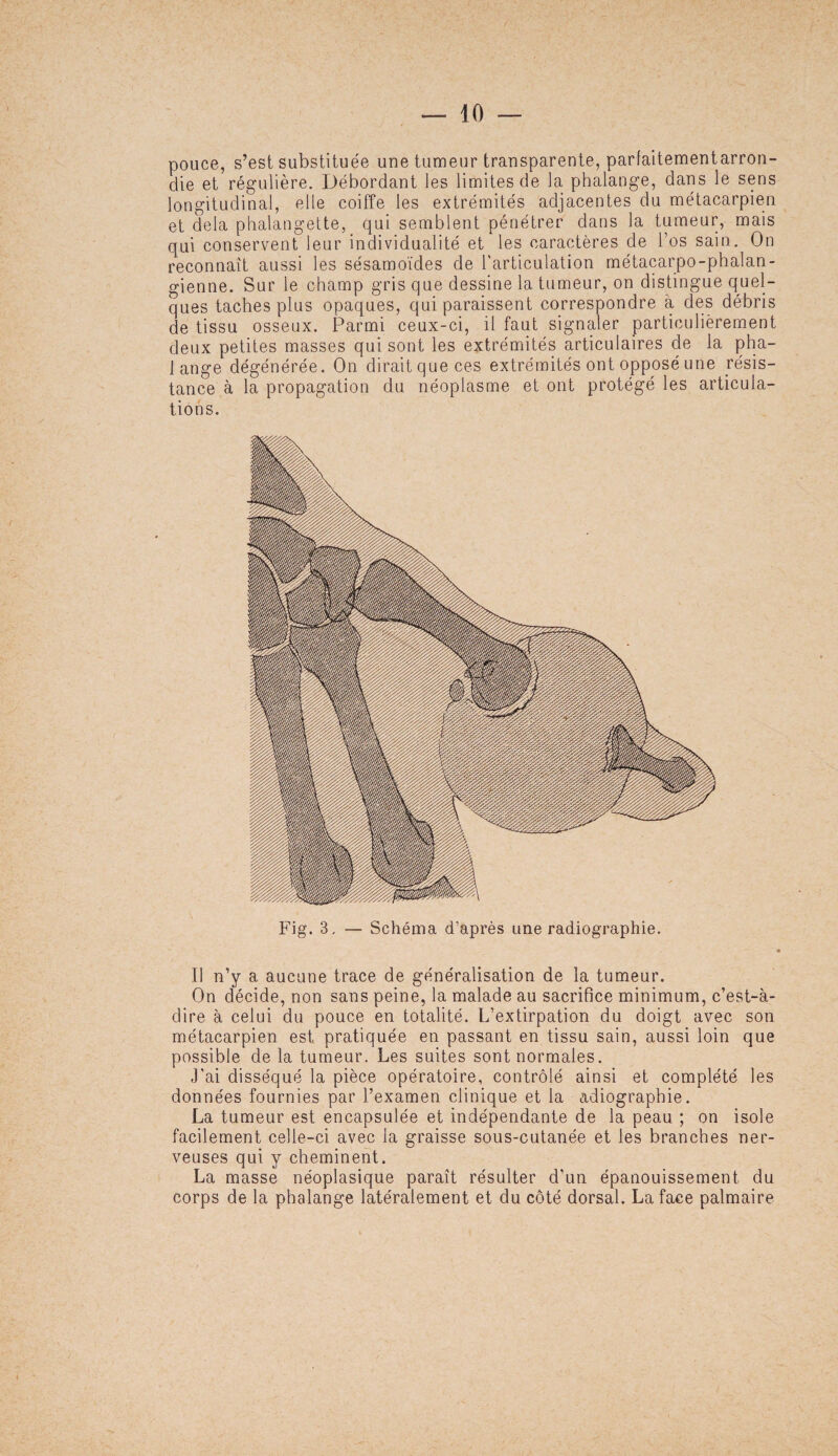 pouce, s’est substituée une tumeur transparente, parfaitementarron- die et régulière. Débordant les limites de la phalange, dans le sens longitudinal, elle coiffe les extrémités adjacentes du métacarpien et delà phalangette, qui semblent pénétrer dans la tumeur, mais qui conservent leur individualité et les caractères de l’os sain. On reconnaît aussi les sésamoïdes de l'articulation métacarpo-phalan¬ gienne. Sur le champ gris que dessine la tumeur, on distingue quel¬ ques taches plus opaques, qui paraissent correspondre a des débris de tissu osseux. Parmi ceux-ci, il faut signaler particulièrement deux petites masses qui sont les extrémités articulaires de la pha- 1 ange dégénérée. On dirait que ces extrémités ont opposé une résis¬ tance à la propagation du néoplasme et ont protégé les articula¬ tions. Fig. 3 — Schéma d’après une radiographie. Il n’y a aucune trace de généralisation de la tumeur. On décide, non sans peine, la malade au sacrifice minimum, c’est-à- dire à celui du pouce en totalité. L’extirpation du doigt avec son métacarpien est pratiquée en passant en tissu sain, aussi loin que possible de la tumeur. Les suites sont normales. J'ai disséqué la pièce opératoire, contrôlé ainsi et complété les données fournies par l’examen clinique et la adiograpbie. La tumeur est encapsulée et indépendante de la peau ; on isole facilement celle-ci avec la graisse sous-cutanée et les branches ner¬ veuses qui y cheminent. La masse néoplasique paraît résulter d’un épanouissement du corps de la phalange latéralement et du côté dorsal. La face palmaire