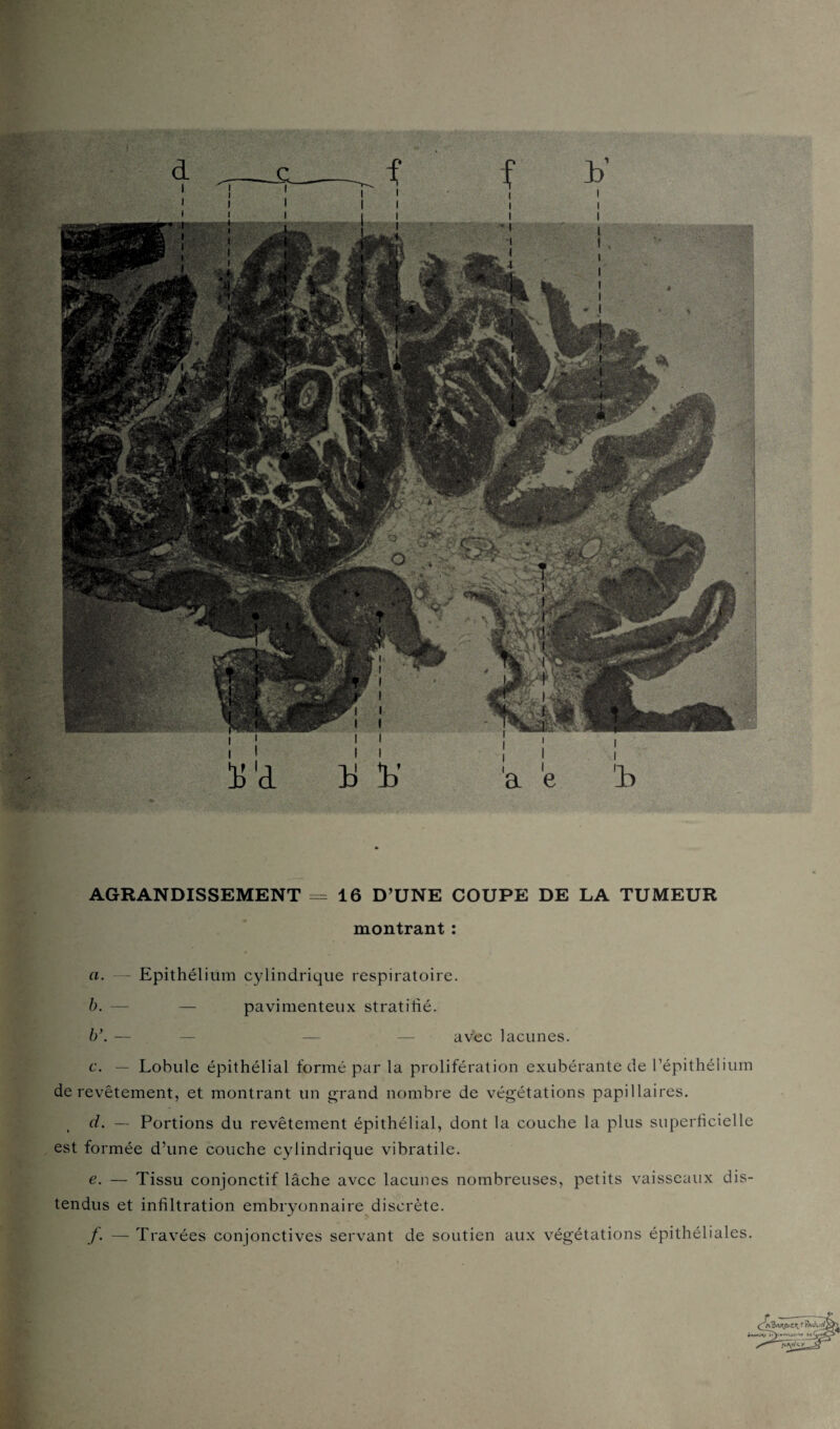 AGRANDISSEMENT = 16 D’UNE COUPE DE LA TUMEUR montrant : a. — Epithélium cylindrique respiratoire. b. —- — pavimenteux stratifié. b\ — — — — avec lacunes. c. — Lobule épithélial formé par la prolifération exubérante de l’épithélium de revêtement, et montrant un grand nombre de végétations papillaires. d. — Portions du revêtement épithélial, dont la couche la plus superficielle est formée d’une couche cylindrique vibratile. e. — Tissu conjonctif lâche avec lacunes nombreuses, petits vaisseaux dis¬ tendus et infiltration embryonnaire discrète. /. — Travées conjonctives servant de soutien aux végétations épithéliales.