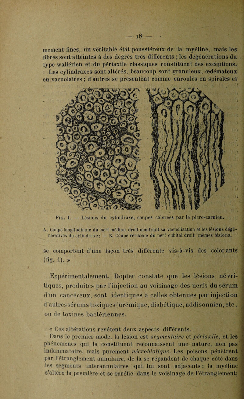 mement fines, un véritable état poussiéreux de la myéline, mais les libres sont;atteintes à des degrés très différents ; les dégénérations du type wallérien et du périaxile classiques constituent des exceptions. Les cylindraxes sont altérés, beaucoup sont granuleux, œdémateux ou vacuolaires ; d’autres se présentent comme enroulés en spirales et Fig. 1. — Lésions du cylindraxe, coupes colorées par le picro-carnien. A, Conpe longitudinale du nerl médian droit montrant sa vacuolisation et lés lésions dégé¬ nératives du cylindraxe; — B, Coupe verticale du nerf cubital droit, mêmes lésions. se comportent d’une façon très différente vis-à-vis des colorants (lig. 1). » Expérimentalement, Dopter constate que les lésions névri- tiques, produites par l’injection au voisinage des nerfs du sérum d’un cancéreux, sont identiques à celles obtenues par injection d'autres sérums toxiques (urémique, diabétique, addisonnien, etc. ou de toxines bactériennes. « Ces altérations revêtent deux aspects différents. Dans le premier mode, la lésion est segmentaire et périaxile, et les phénomènes qui la constituent reconnaissent une nature, non pas inflammatoire, mais purement nécrobiolique. Les poisons pénètrent par l’étranglement annulaire, de là se répandent de chaque côté dans les segments interannulaires qui lui sont adjacents ; la myéline s’altère la première et se raréfie dans le voisinage de l’étranglement;