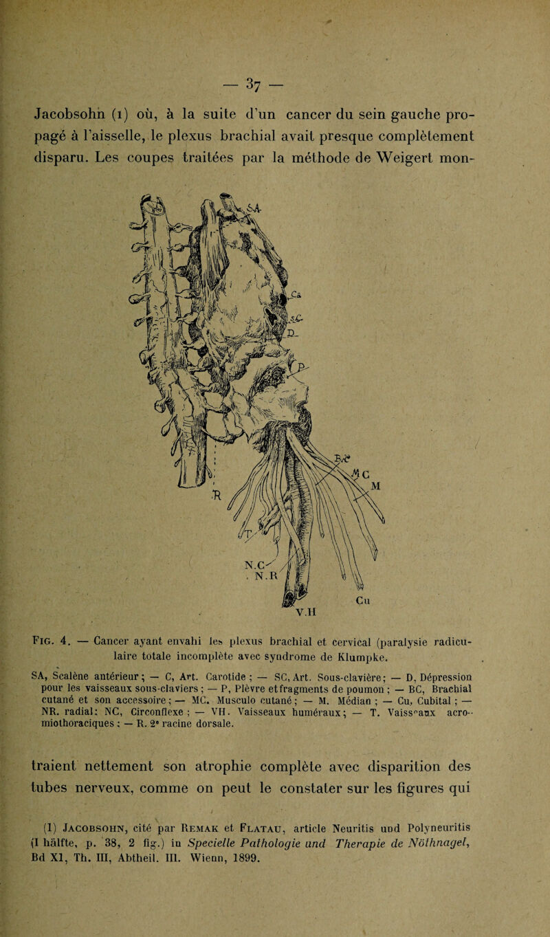 Jacobsohn (1) où, à la suite d’un cancer du sein gauche pro¬ pagé à l’aisselle, le plexus brachial avait presque complètement disparu. Les coupes traitées par la méthode de Weigert mon- Fig. 4. — Cancer ayant envahi les plexus brachial et cervical (paralysie radicu¬ laire totale incomplète avec syndrome de Klumpke. SA, Scalène antérieur; — C, Art. Carotide; — SC, Art. Sous-clavière; — D, Dépression pour les vaisseaux sous-claviers ; — P, Plèvre etfragments de poumon ; — BC, Brachial cutané et son accessoire ; — MC. Musculo cutané ; — M. Médian ; — Cu, Cubital ; — NR. radial; NC, Circonflexe; — VH. Vaisseaux huméraux; — T. Vaisseaux acro-- miothoraciques ; — R. 2° racine dorsale. traient nettement son atrophie complète avec disparition des tubes nerveux, comme on peut le constater sur les figures qui (1) Jacobsohn, cité par Remak et Flatau, article Neuritis und Polyneuritis (I hâlfte, p. 38, 2 fig.) in Specielle Pathologie and Thérapie de Nôthnagel, Bd XI, Th. III, Abtheil. III. Wienn, 1899.