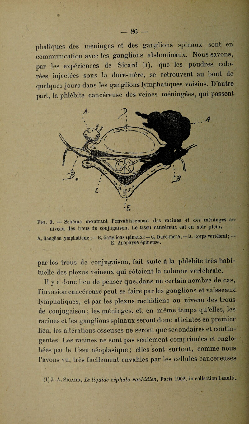 phatiques des méninges et des ganglions spinaux sont en communication avec les ganglions abdominaux. Nous savons, par les expériences de Sicard (1), que les poudres colo¬ rées injectées sous la dure-mère, se retrouvent au bout de quelques jours dans les ganglions lymphatiques voisins. D autre part, la phlébite cancéreuse des veines méningées, qui passent £ pIG 9, _ Schéma montrant l’envahissement des racines et des méninges au niveau des trous de conjugaison. Le tissu cancéreux, est en noir plein. A, Ganglion lymphatique ; —B, Ganglions spinaux ; — C, Dure-mère ; D, Corps vertébral, —— E, Apophyse épineuse. par les trous de conjugaison, fait suite à la phlébite très habi¬ tuelle des plexus veineux qui côtoient la colonne vertébrale. Il y a donc lieu de penser que, dans un certain nombre de cas, l’invasion cancéreuse peut se faire par les ganglions et vaisseaux lymphatiques, et par les plexus rachidiens au niveau des trous de conjugaison ; les méninges, et, en même temps qu’elles, les racines et les ganglions spinaux seront donc atteintes en premier lieu, les altérations osseuses ne seront que secondaires et contin¬ gentes. Les racines ne sont pas seulement comprimées et englo¬ bées par le tissu néoplasique ; elles sont surtout, comme nous l’avons vu, très facilement envahies par les cellules cancéreuses (1) J.-A. Sicard, Le liquide céphalo-rachidien, Paris 1902, in collection Léauté.