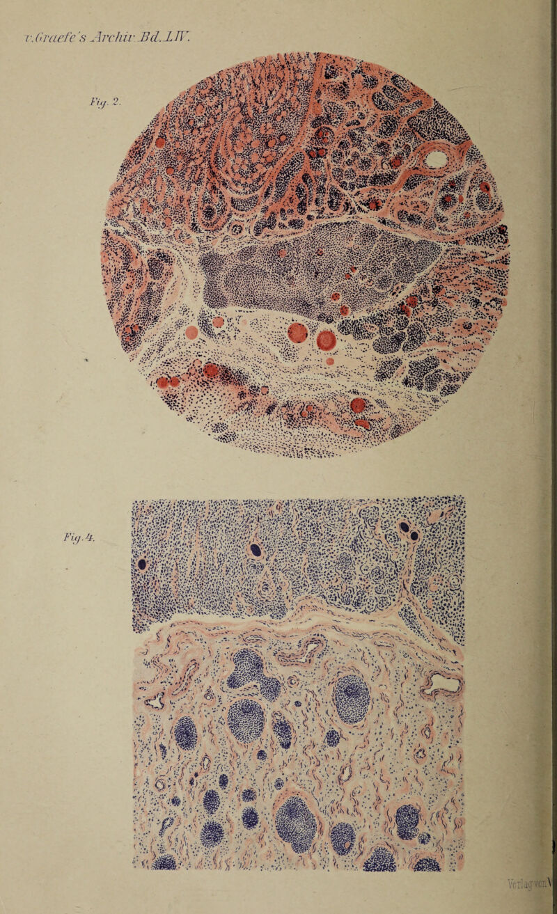 T.Graefe's Fig. Archiv Bcl.JLIlh Fitj. 2. 4. r fl \