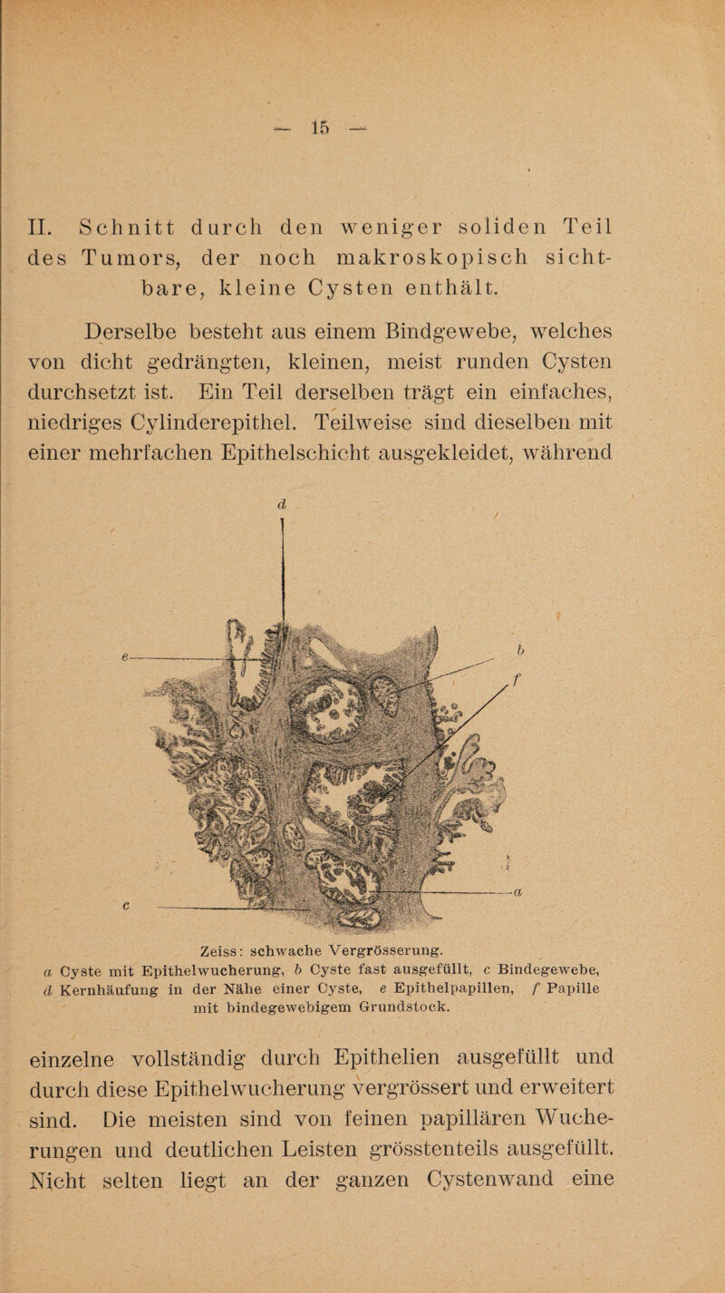 II. Schnitt durch den weniger soliden Teil des Tumors, der noch makroskopisch sicht¬ bare, kleine Cysten enthält. Derselbe besteht aus einem Bindgewebe, welches von dicht gedrängten, kleinen, meist runden Cysten durchsetzt ist. Ein Teil derselben trägt ein einfaches, niedriges Cylinderepithel. Teilweise sind dieselben mit einer mehrfachen Epithelschicht ausgekleidet, während d Zeiss: schwache Vergrösserung. a Cyste mit Epithelwucherung, b Cyste fast ausgefüllt, c Bindegewebe, d Kernhäufung in der Nähe einer Cyste, e Epithelpapillen, f Papille mit bindegewebigem Grundstock. einzelne vollständig durch Epithelien ausgefüllt und durch diese Epithelwucherung vergrössert und erweitert sind. Die meisten sind von feinen papillären Wuche¬ rungen und deutlichen Leisten grösstenteils ausgefüllt. Nicht selten liegt an der ganzen Cystenwand eine