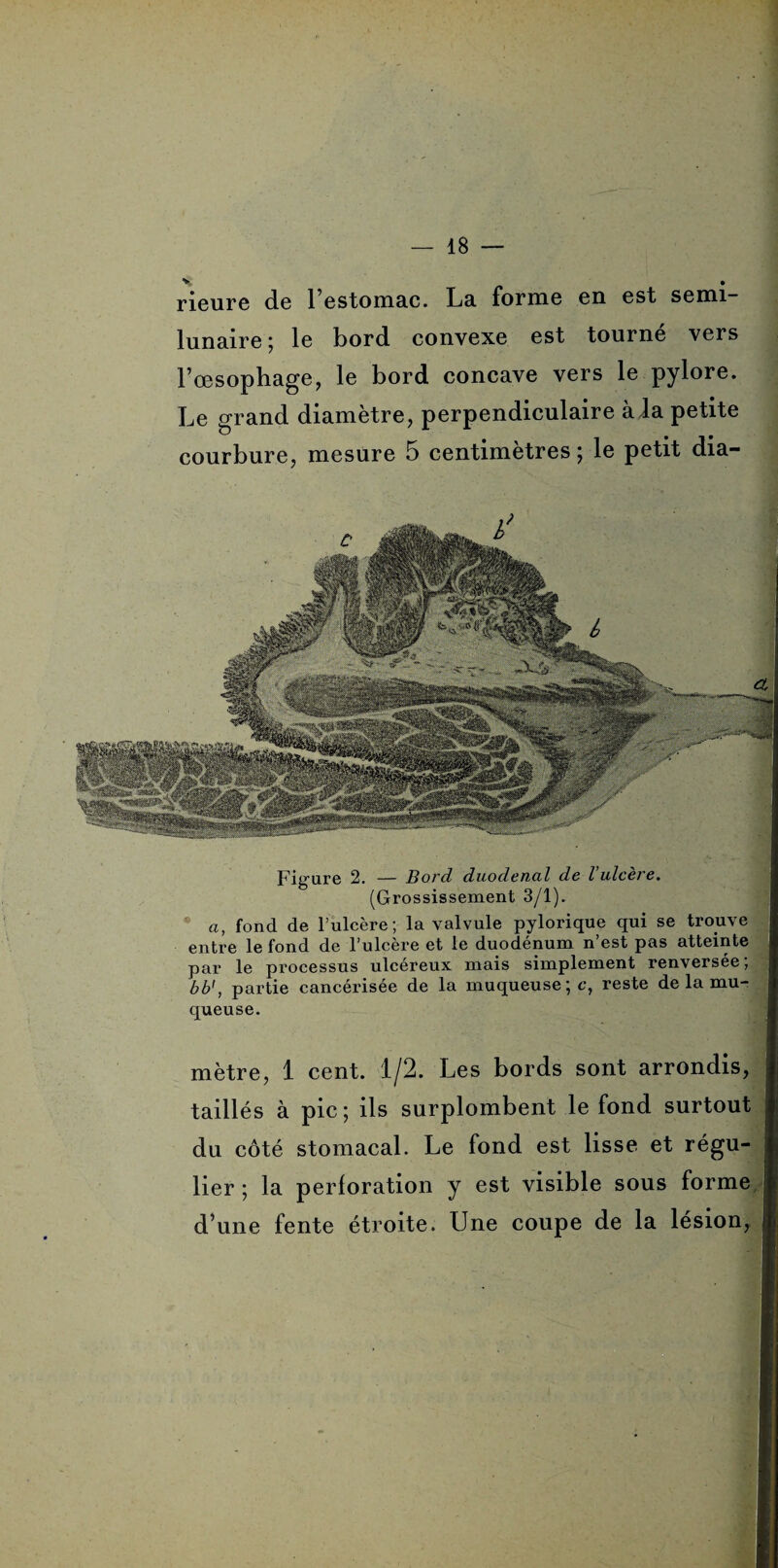 rieure de l’estomac. La forme en est semi- lunaire; le bord convexe est tourné vers l’œsophage, le bord concave vers le pylore. Le grand diamètre, perpendiculaire à la petite courbure, mesure 5 centimètres; le petit dia- Fig’ure 2. — Bord duodenal de l'ulcère. (Grossissement 3/1). a, fond de l’ulcère; la valvule pylorique qui se trouve entre le fond de l’ulcère et le duodénum n’est pas atteinte par le processus ulcéreux mais simplement renversée; bb', partie cancérisée de la muqueuse ; c, reste de la mu¬ queuse. mètre, 1 cent. 1/2. Les bords sont arrondis, taillés à pic; ils surplombent le fond surtout ; du côté stomacal. Le fond est lisse et régu- j lier ; la perforation y est visible sous forme j d’une fente étroite. Une coupe de la lésion, (j