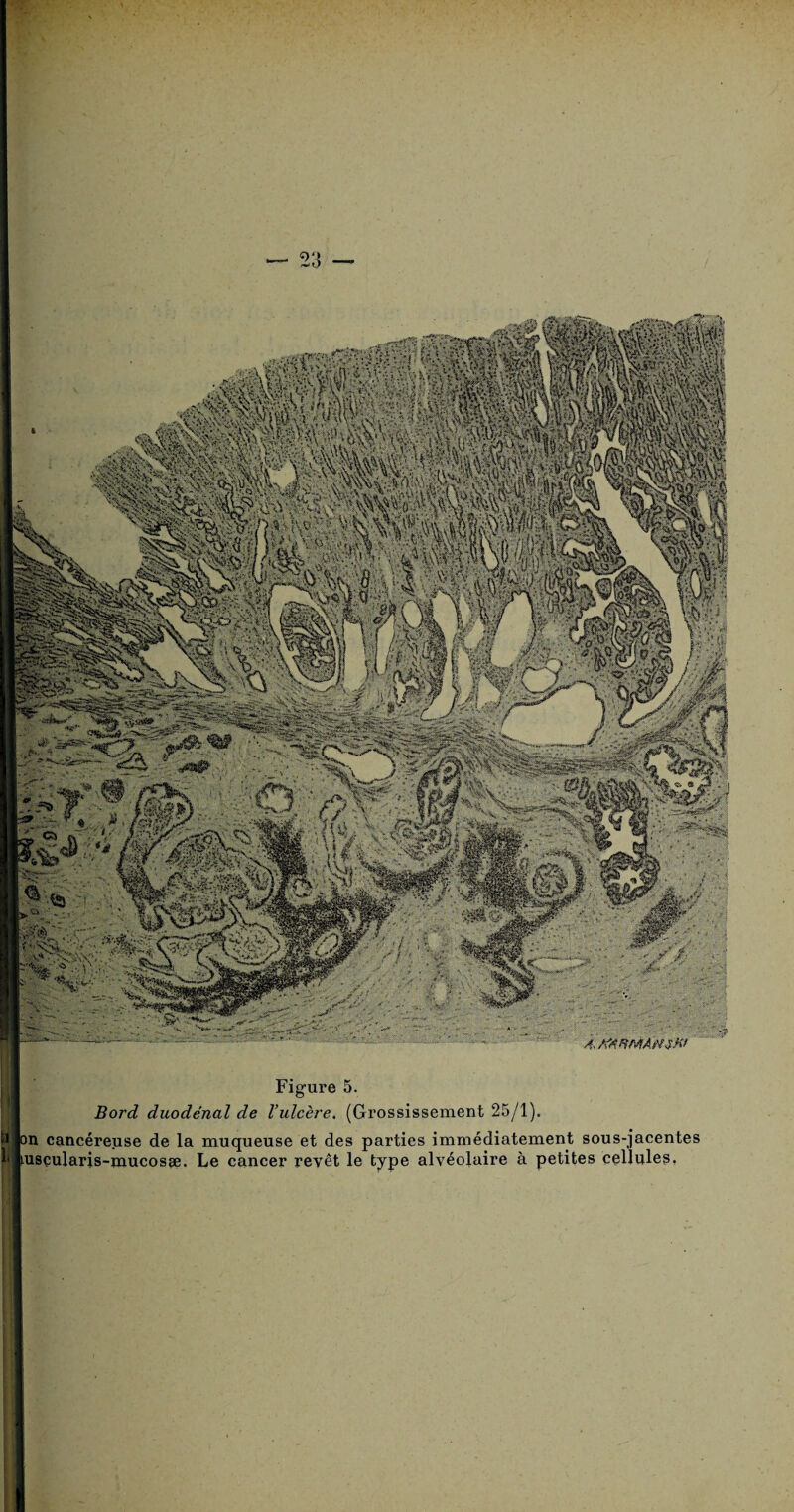 Figure 5. Bord duodénal de l’ulcère. (Grossissement 25/1). Il on cancéreuse de la muqueuse et des parties immédiatement sous-jacentes Lusçularis-mucosæ. Le cancer revêt le type alvéolaire à petites cellules. ' ' -, . ’ ' . * - . i