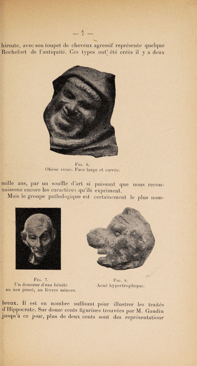 hirsute, avec son toupet cle cheveux agressif represente quelque Rochefort de l’antiqnite. Ges types ont- ete crees il y a deux Fig. 6. Obese rieur. Face large et carree. mille ans, par un souffle d’art si puissant que nous recon- naissons encore les caracteres qu’ils expriment. Mais le groupe pathologique est certainement le plus norn- Fig. 7. Un donneur d’eau benite au nez pince, au levres minces. Fig. 8. Acne hypertrophique. breux. II est en nombre suffisant pour illustrer les traites d Hippocrate. Sur douze cents figurines trouvees par M. Gaudin jusqu a ce jour, plus de deux cents sont des representation?