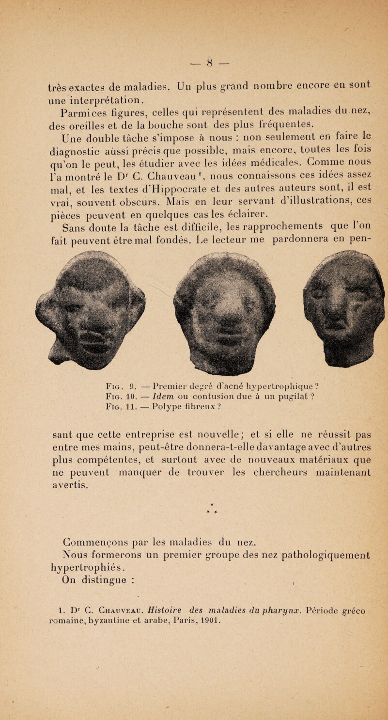 tresexactes de maladies. Un plus grand nombre encore en sont une interpretation. Parmices figures, celles qui represented des maladies du nez, des oreilles et de la bouche sont des plus frequentes. Une double tache s’impose a nous : non seulement en faire le diagnostic aiissi precis que possible, mais encore, toutes les fois qu’on le peut, les etudier avec les idees medicales. Comme nous l a montre le Dr G. Chauveaub nous connaissons ces idees assez mal, et les textes d’Hippocrate et des autres auteurs sont, il est vrai, souvent obscurs. Mais en leur servant d’illustrations, ces pieces peuvent en quelques cas les eclairer. Sans doute la tache est difficile, les rapprochements que 1 on fait peuvent etre mal fondes. Le lecteur me pardonnera en pen- Fig. 9. —Premier degre d’acne hypertrophique? Fig. 10. — Idem ou contusion due a un pugilat ? Fig. 11. — Polype fibreux ? sant que cette entreprise est nouvelle; et si elle ne reussit pas entre mes mains, peut-etre donnera-t-elle davantage avec d’autres plus competentes, et surtout avec de nouveaux materiaux que ne peuvent manquer de trouver les chercheurs maintenant avertis. Gommencons par les maladies du nez. Nous formerons un premier groupe des nez pathologiquement hypertrophies. On distingue : v , 1. Dr G. Chauveau. Histowe des maladies du pharynx. Periode greco romaine, byzantine et arabe, Paris, 1901.