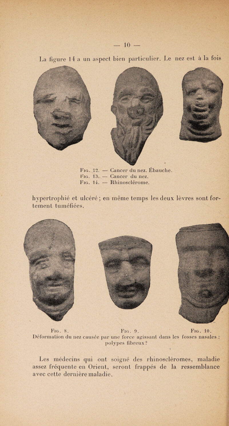 La figure 14 a un aspect bien particulier. Le nez est a la fois Fig. 12. — Fig. 13. — Fig. 14. — Cancer clu nez. Ebauche. Cancer du nez. Rhinosclerome. bypertrophie et ulcere; en meme temps les cleux levres sont for- tement tumefiees. Fig. 8. Fig. 9. Fig. 10. Deformation du nez causee par une force agissant dans les fosses nasales polypes fibreux? Les medecins qui out soigne des rhinoscleromes, maladie assez frequente en Orient, seront frappes de la ressemblance avec cette derniere maladie. *