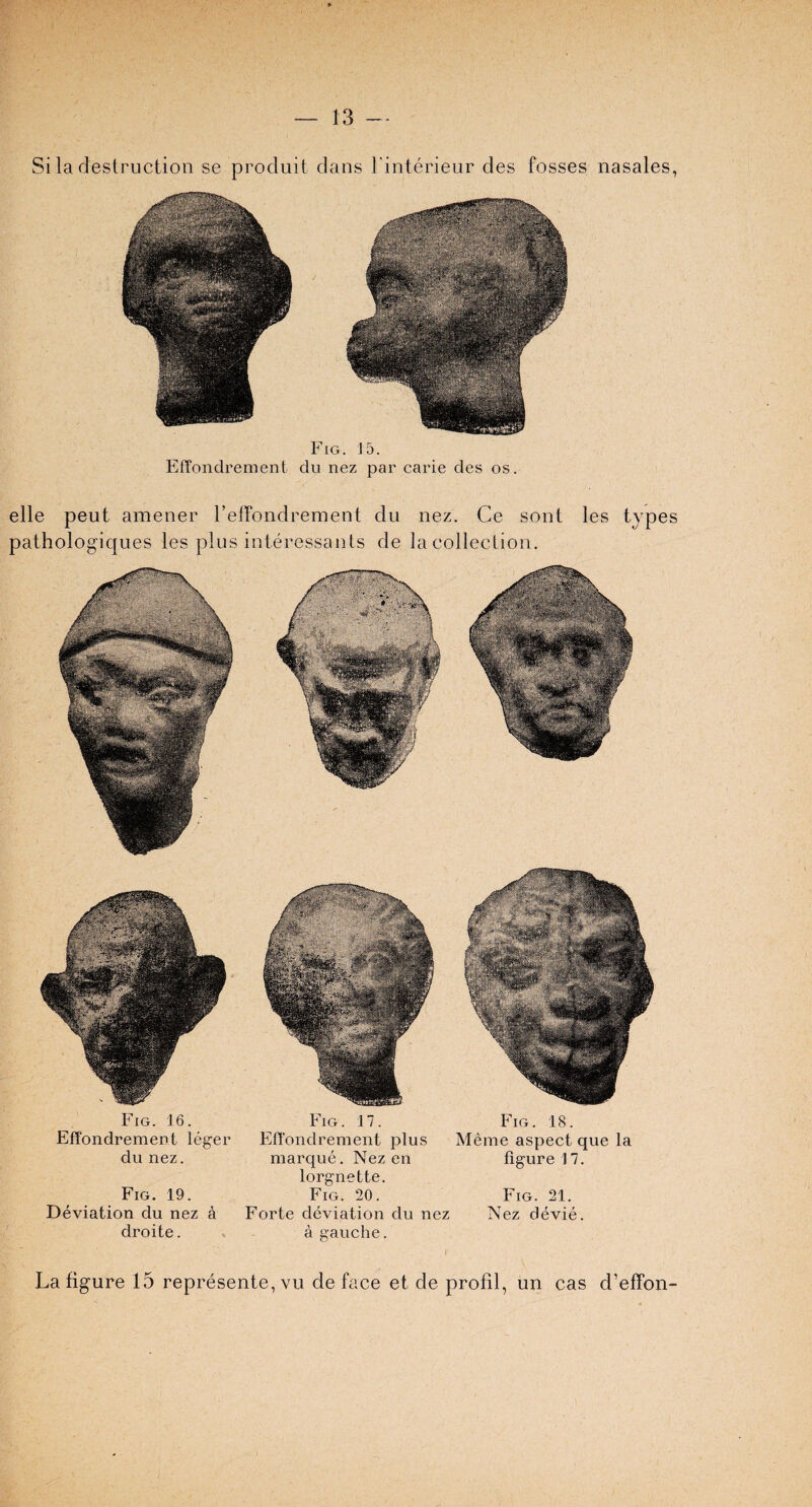 Si la destruction se produit dans l’interieur des fosses nasales, Fig. 15. Effondrement du nez par carie des os. elle peut amener reffondrement du nez. Ce sont les types pathologiques les plus interessants de la collection. Fig. 16. Effondrement leger du nez. Fig. 19. Deviation du nez a droite. Fig. 17. Effondrement plus marque. Nez en lorgnette. Fig. 20. Forte deviation du nez a gauche. Fig. 18. Meme aspect que la figure 17. Fig. 21. Nez devie. La figure 15 represente, vu de face et de profil, un cas d’effon