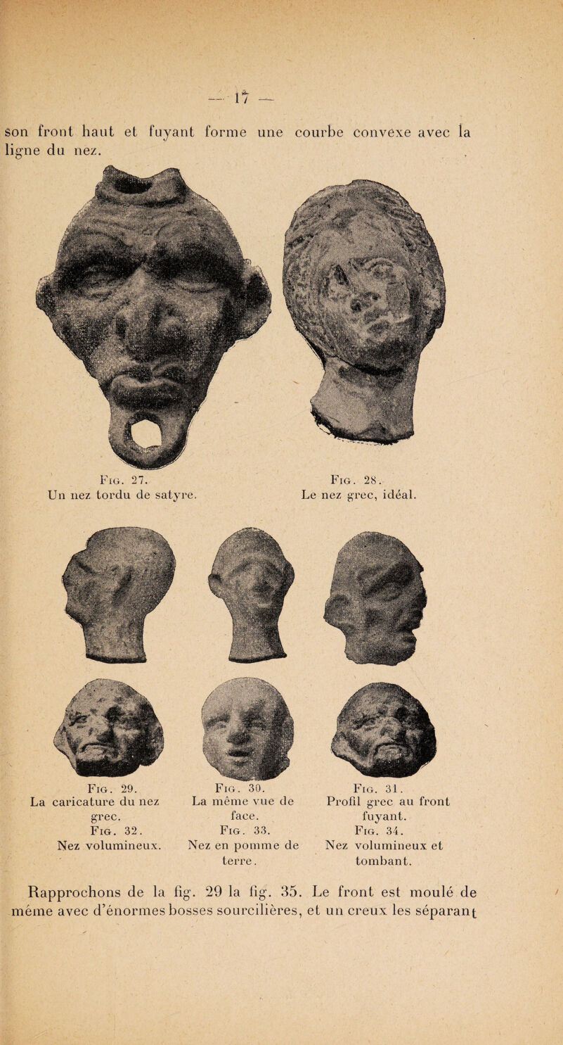 son front haut et fuyant forme une courbe convexe avec ligne du nez. Fig. 27. Un nez tordu de satyre. Fig. 28. Le nez grec, ideal. la Rapprochons de la fig. 29 la fig. 35. Le front est moule de meme avec d’enormes bosses sourcilieres, et un creux les separant Fig. 29. La caricature du nez grec. Fig. 32. Nez volumineux. Fig. 30. La meme vue de face. Fig. 33. Nez en pomme de terre. Fig. 31. Profit grec au front fuyant. Fig. 34. Nez volumineux et tombant.