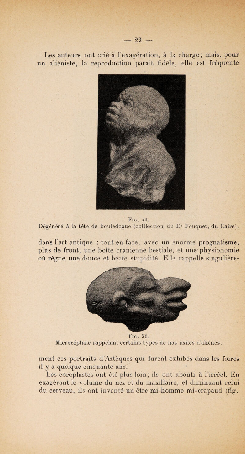 Les auteurs ont crie a Fexageration, a la charge; mais, pour un alieniste, la reproduction parait fidele, elle est frequente Fig. 49. Degenere a la tete de bouledogue (colllection du Dr Fouquet, du Caire). dans Fart antique : tout en face, avec un enorme prognatisme, plus de front, une boite cranienne bestiale, et une physionomie oil regne une douce et beate stupidite. Elle rappelle singuliere- Fig. 50. Microcephale rappelant certains types de nos asiles d'alienes. ment ces portraits d’Azteques qui furent exhibes dans les foires il y a quelque cinquante ansC 1 Les coroplastes ont ete plus loin; ils ont abouti a Firreel. En exagerant le volume du nez et du maxillaire, et diminuant celui du cerveau, ils ont invente un etre mi-homme mi-crapaud (fig.