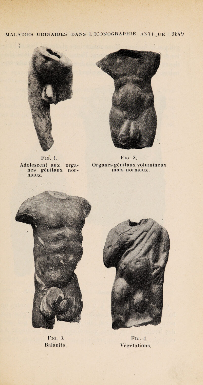 Fig. 1. Fig. 2. Adolescent aux orga- Organes genitaux volumineux nes genitaux nor- mais normaux. raaux. Fig. 3. Balanite Fig. 4. Vegetations